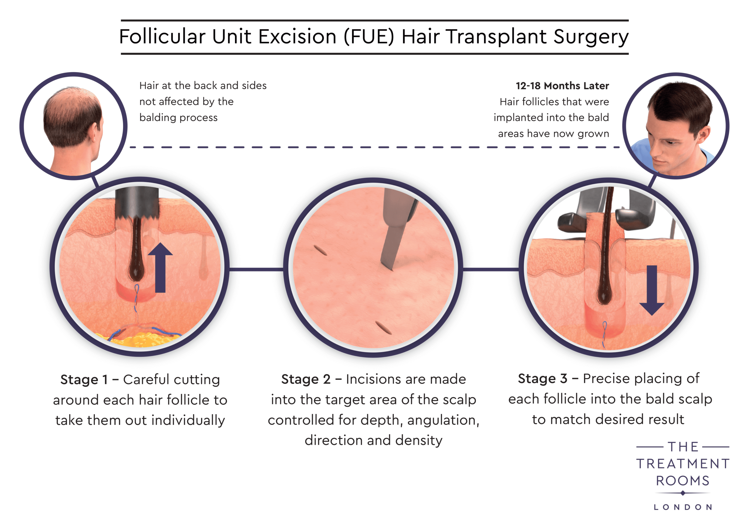 FUE hair transplant surgery diagram