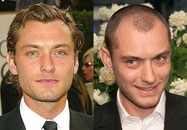 Jude Law Hair Transplant | The Treatment Rooms London Jude Law Hair Transplant | The Treatment Rooms London