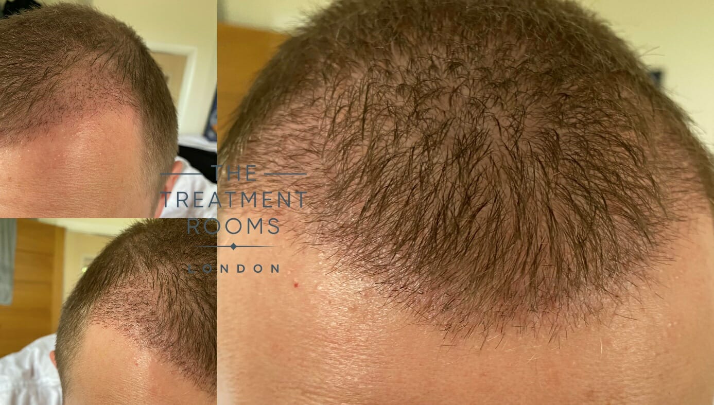 Hair transplant after one month - Treatment Rooms London