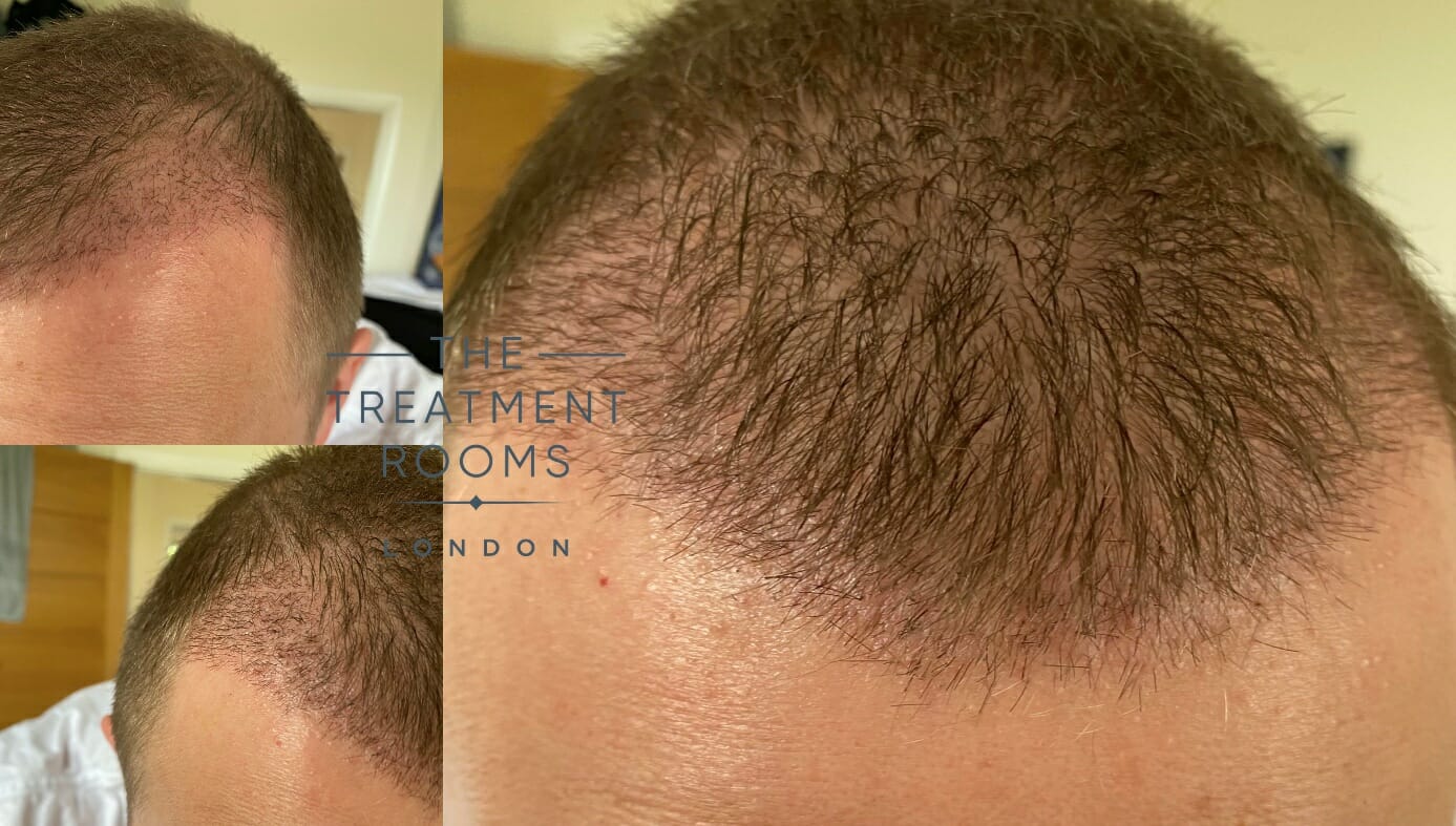 How To Prevent Infection After Hair Transplant  Hair Sure