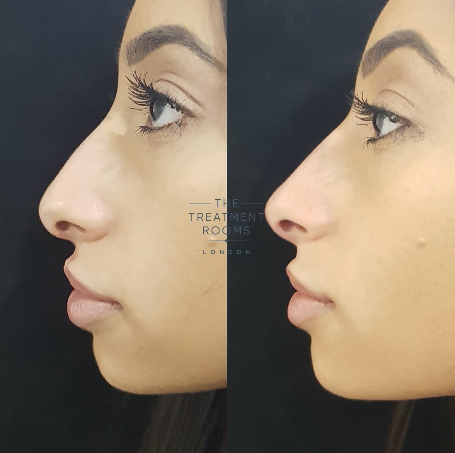 Non-surgical Nose Job