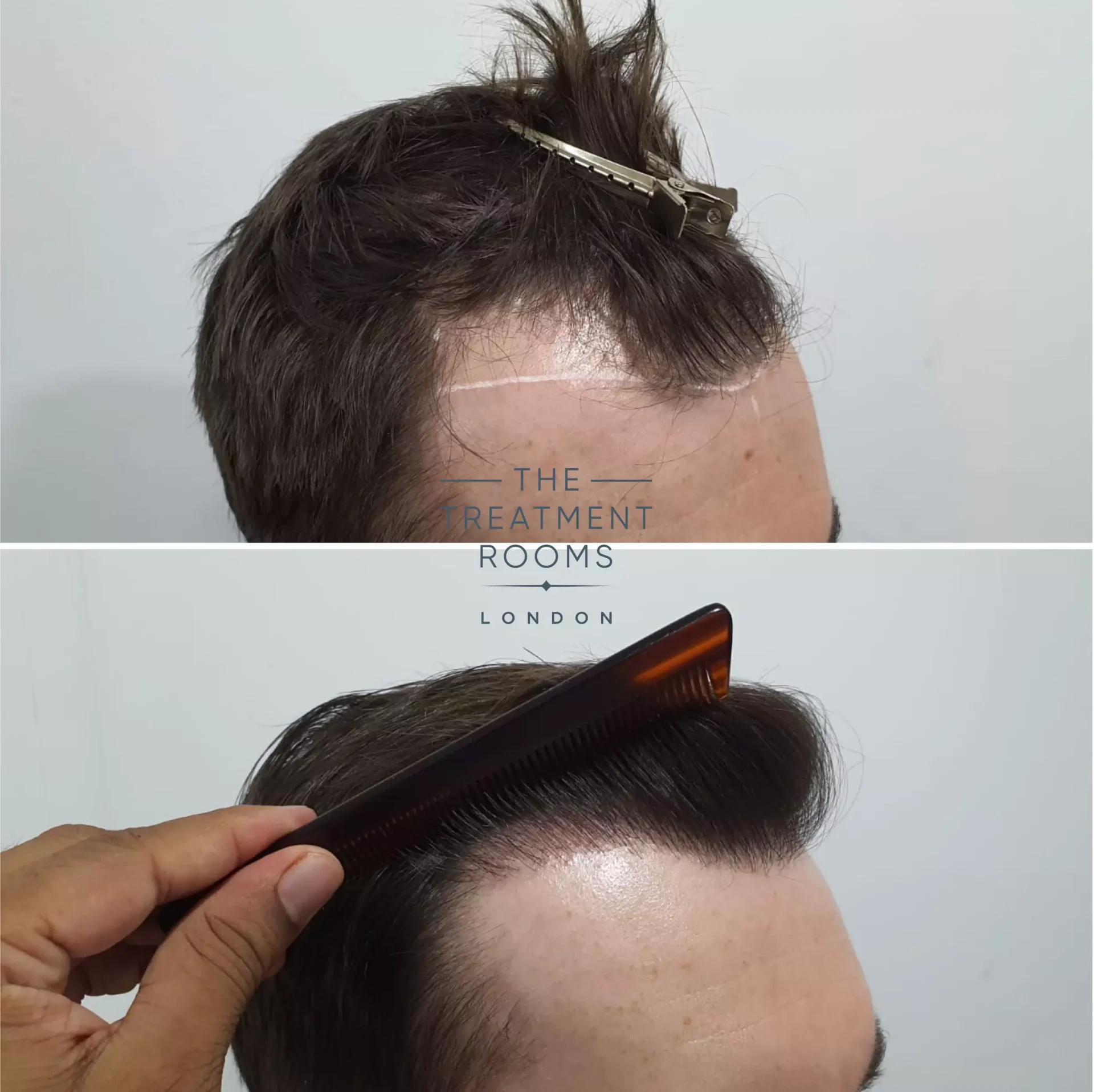 1014 grafts best hair transplant clinic london before and after