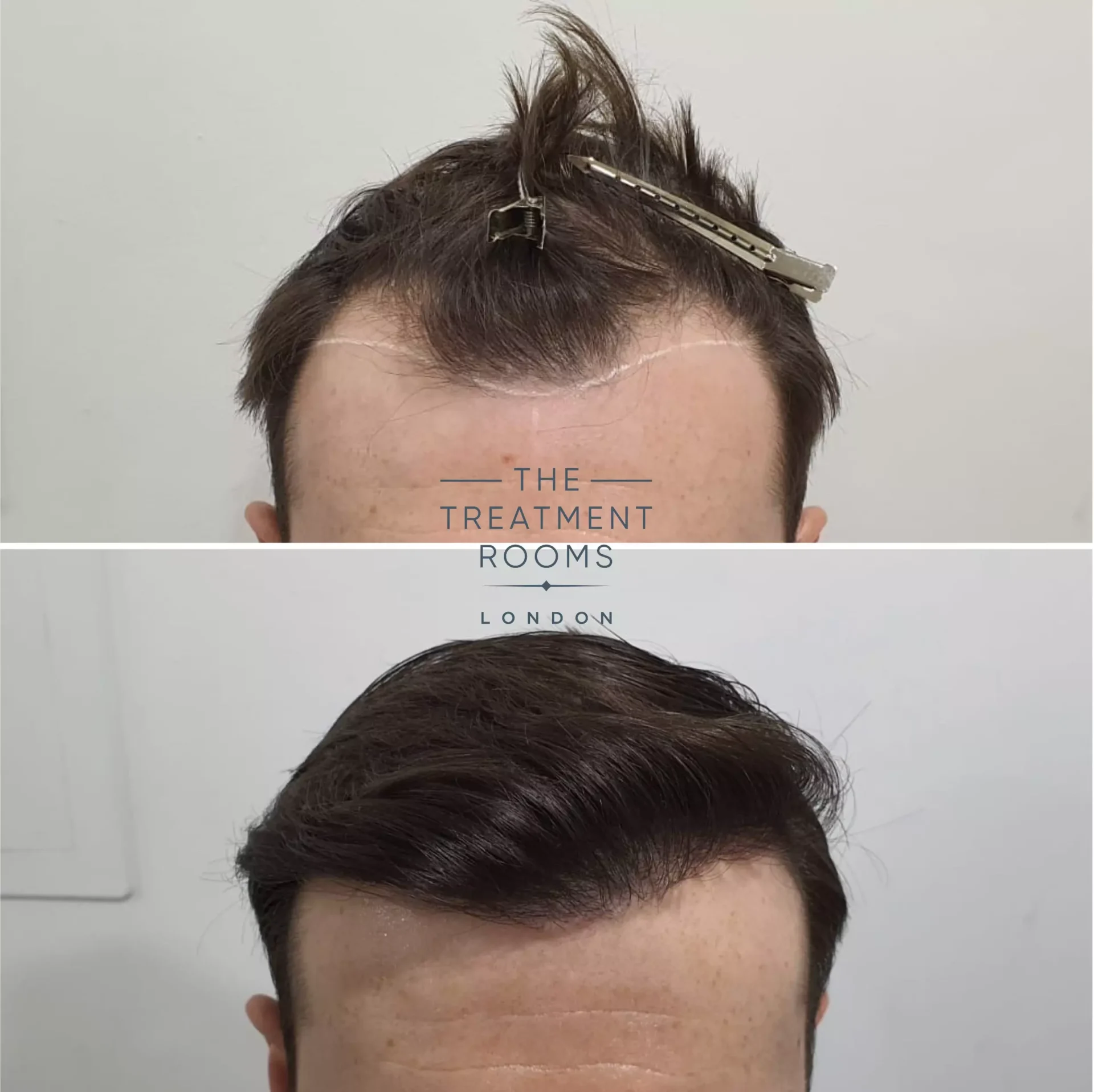 1014 grafts temple fue hair transplant before and after