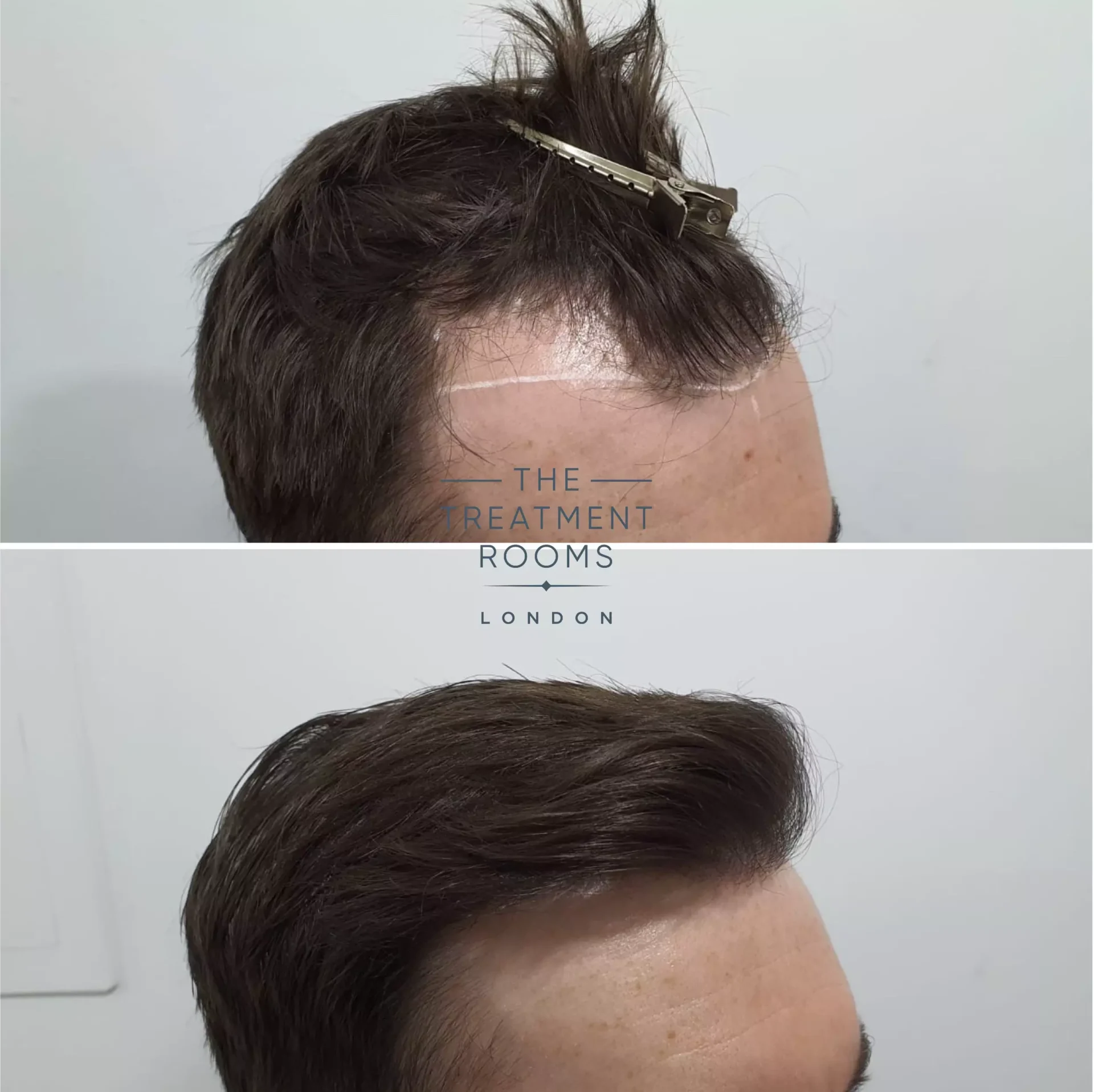 1014 grafts temple hair transplant before and after