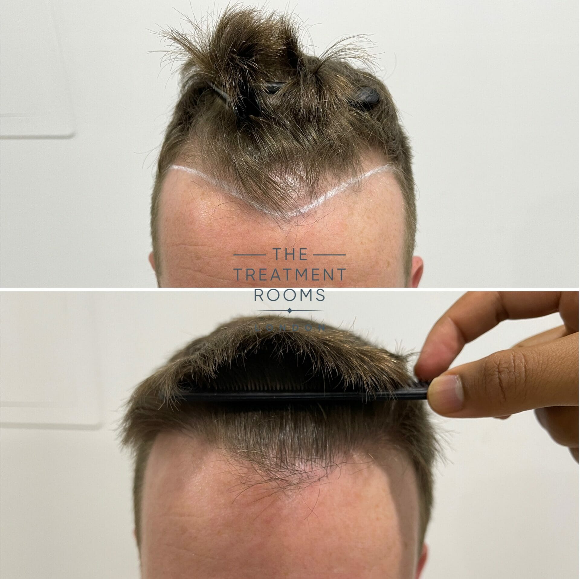 1073 grafts fue hair transplant before and after closeup