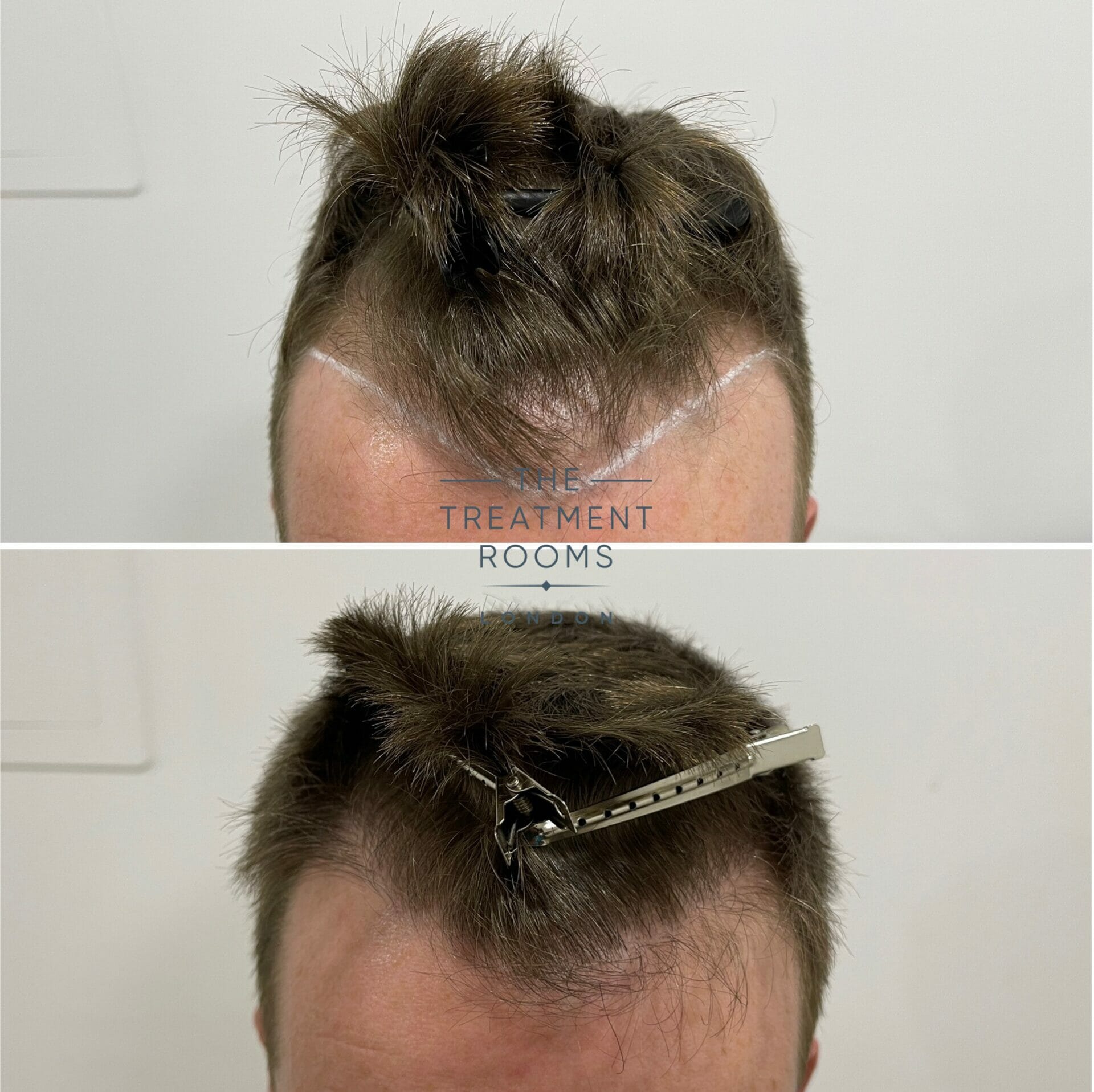 1073 grafts hairline and cowlick hair transplant result