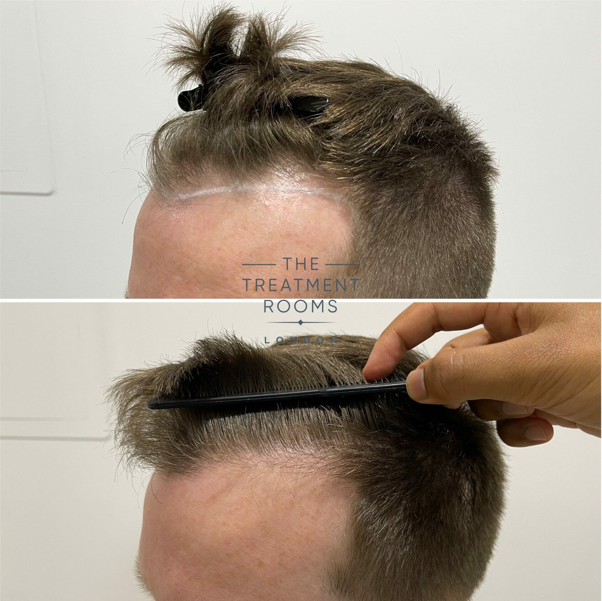 1073 grafts temple fue hair transplant before and after closeup