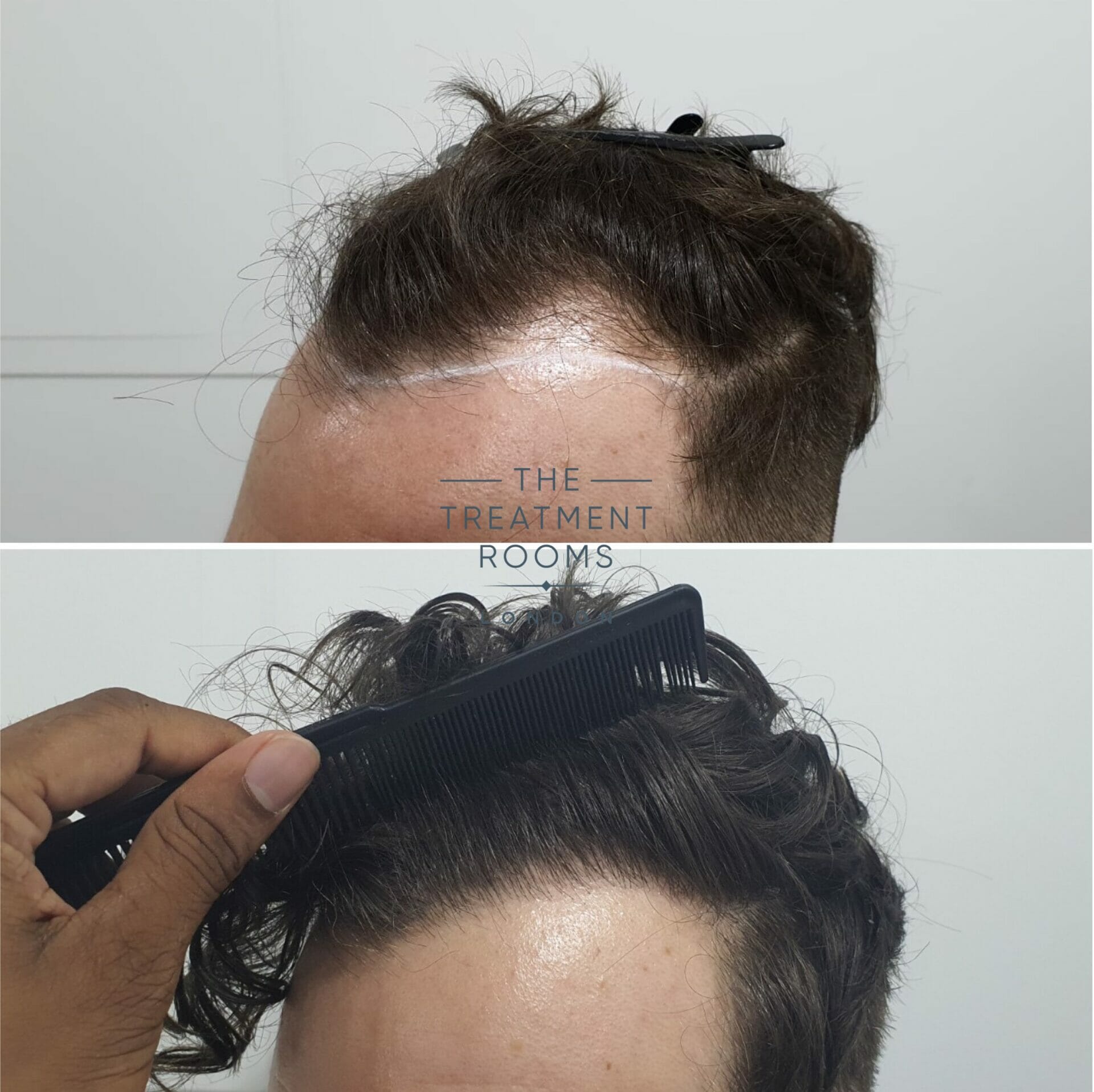 1194 grafts hair transplant