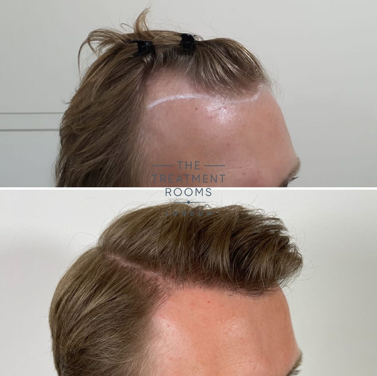 before and after fue hair transplant hairline