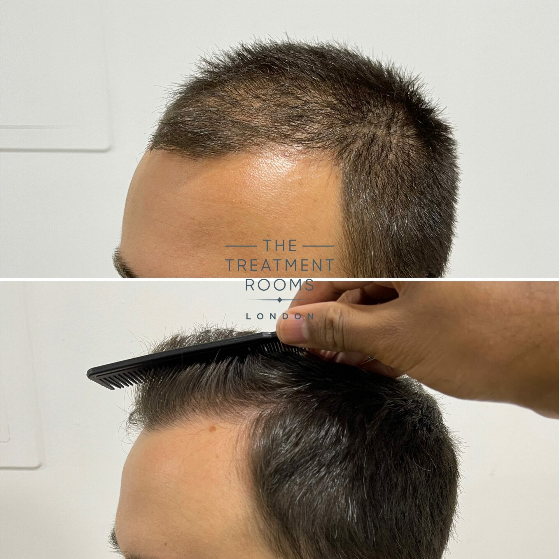 1240 grafts FUE hair transplant result