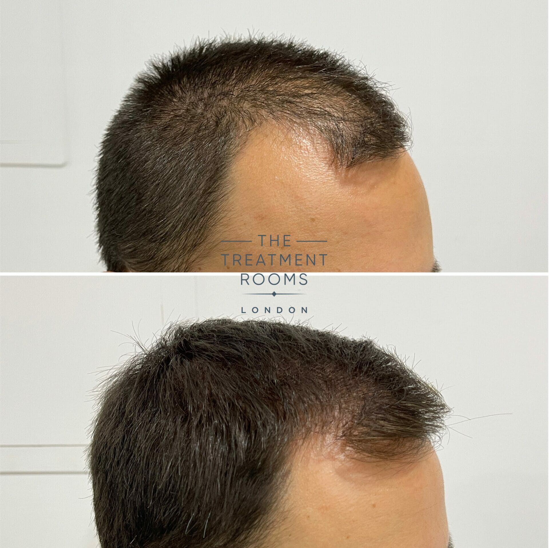 1240 grafts fue hair transplant before and after