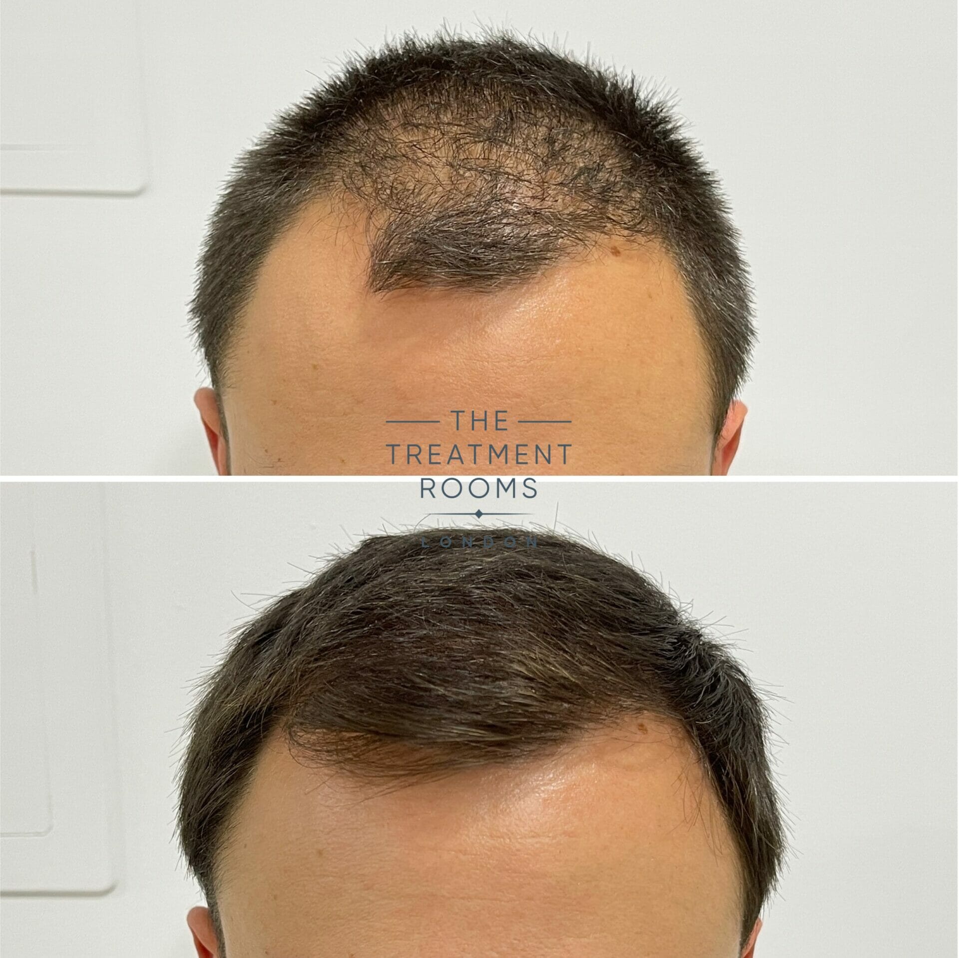 1240 grafts hair transplant before and after