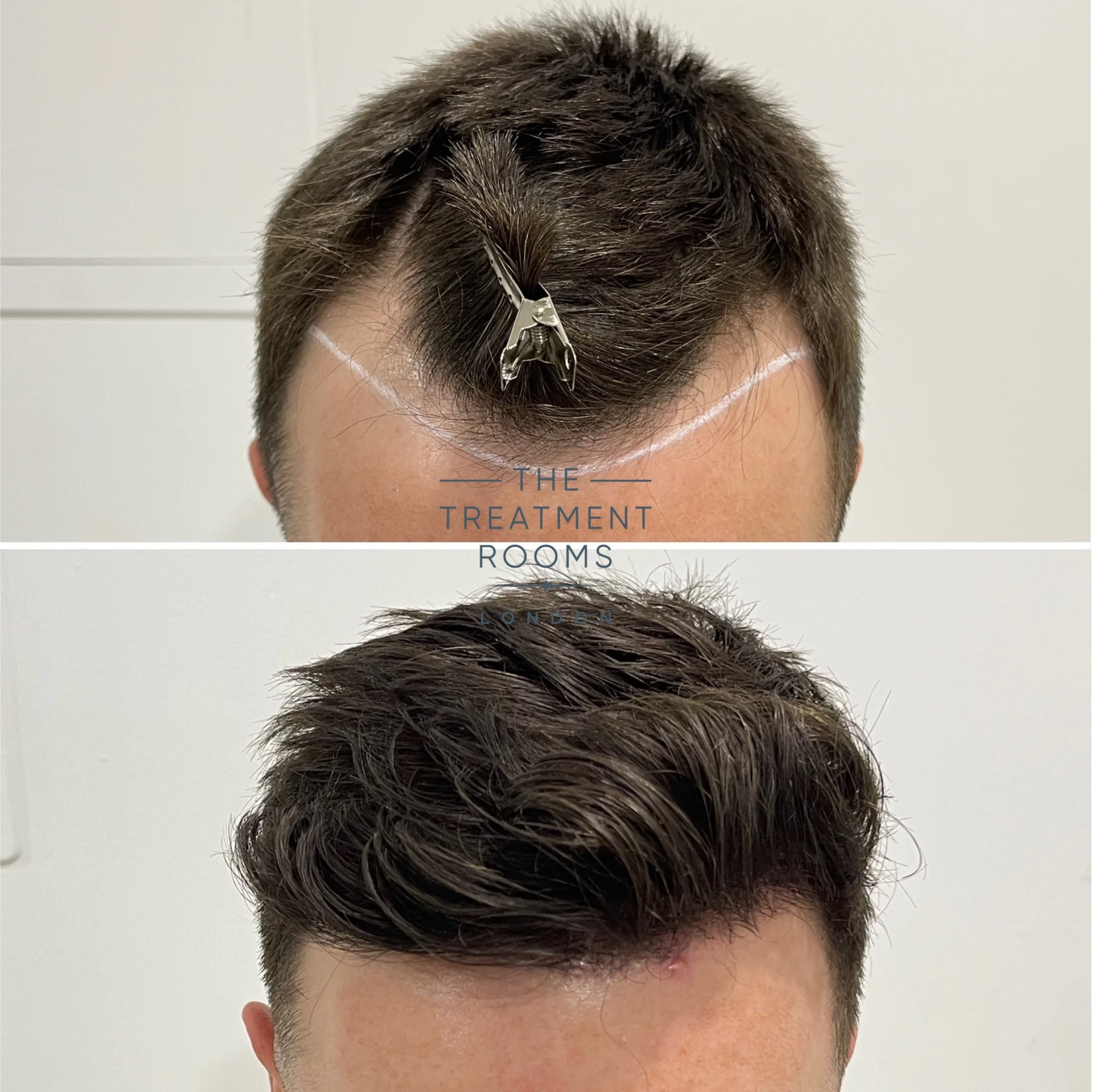 1370 grafts best hair transplant london before and after hairline