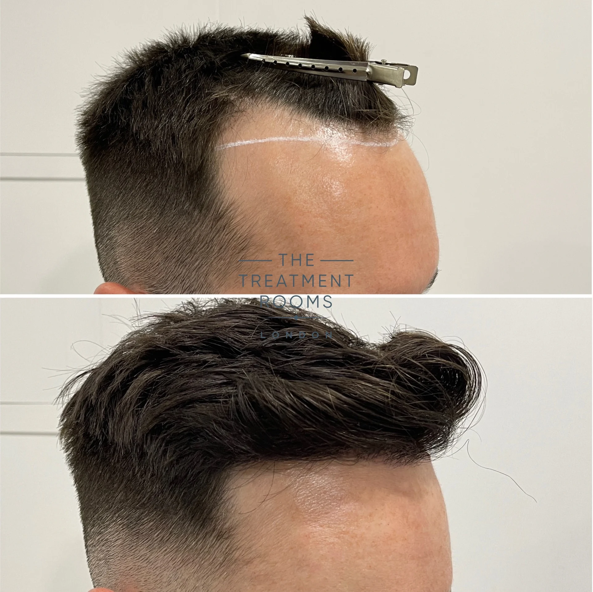 1370 grafts hairline fue hair transplant before and after