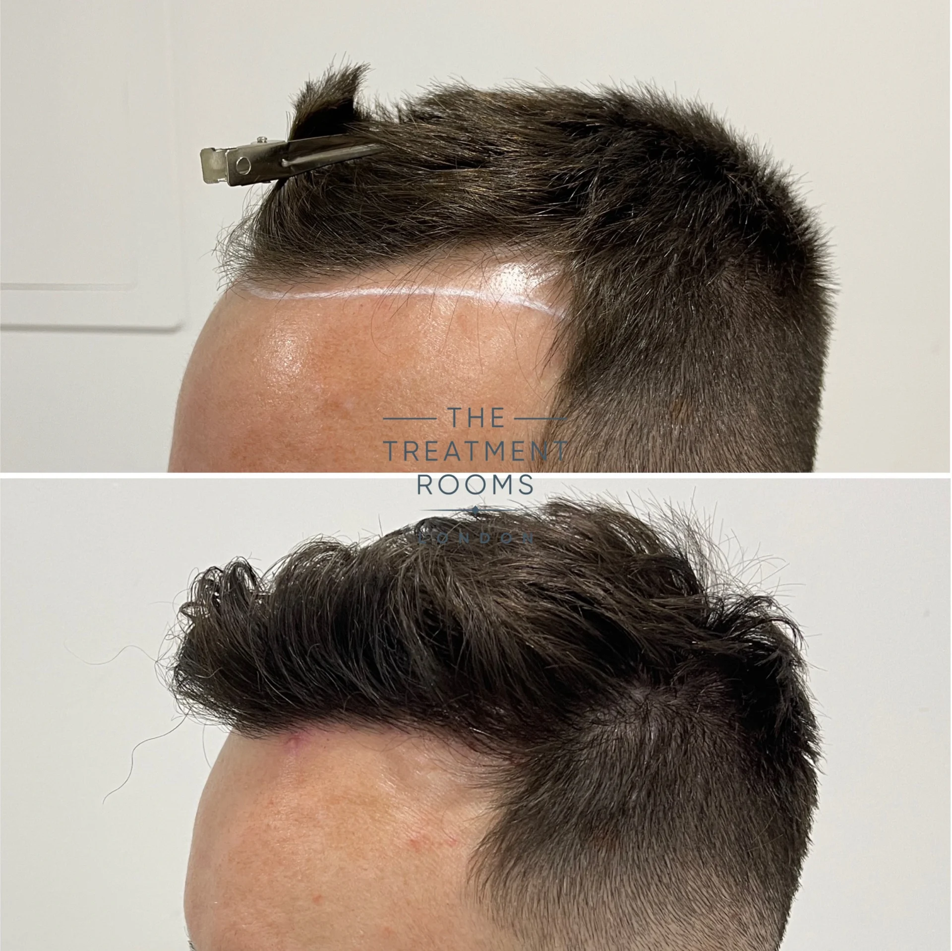1370 grafts hairline fue hair transplant london before and after