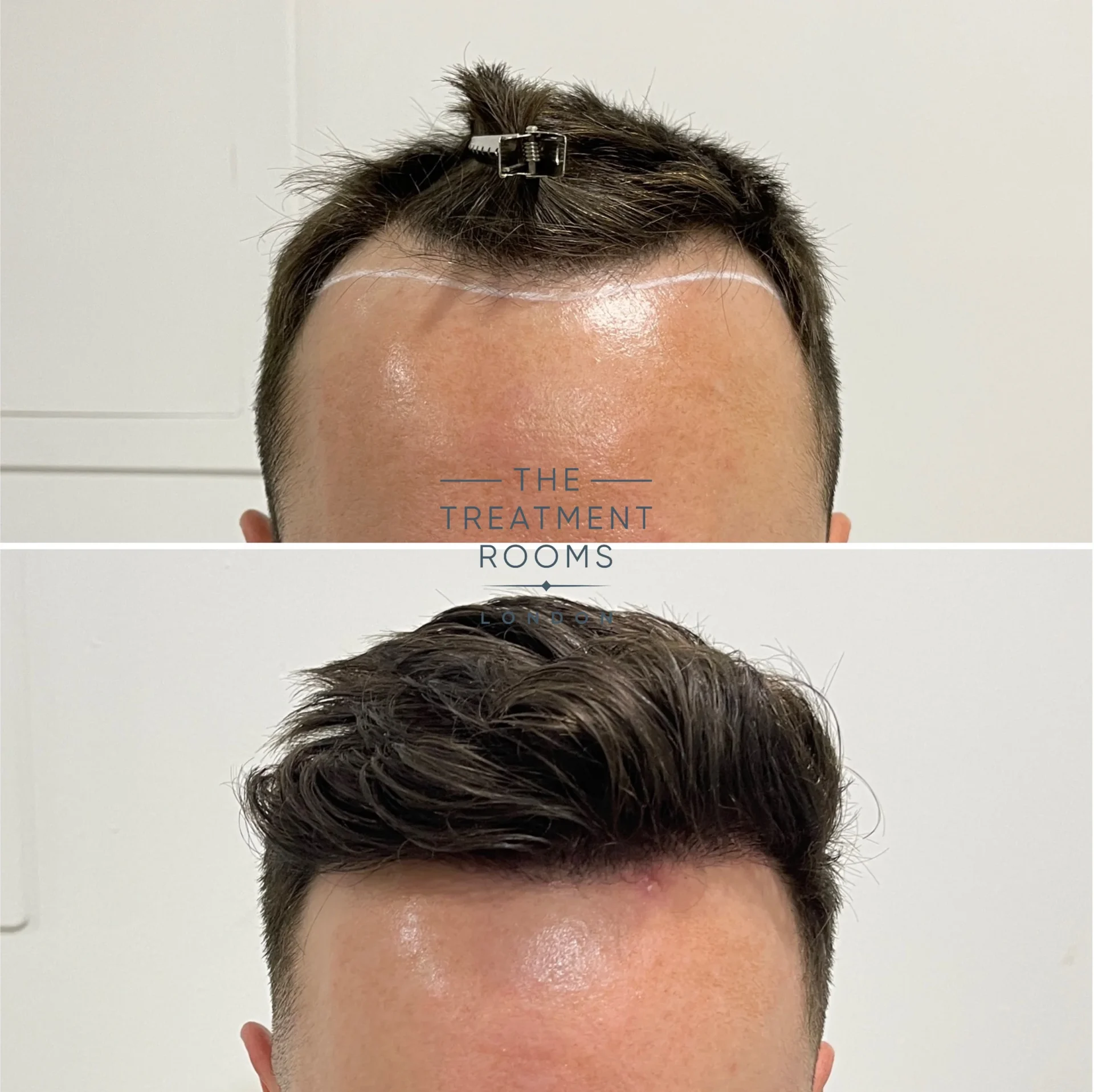 1370 grafts hairline hair transplant before and after