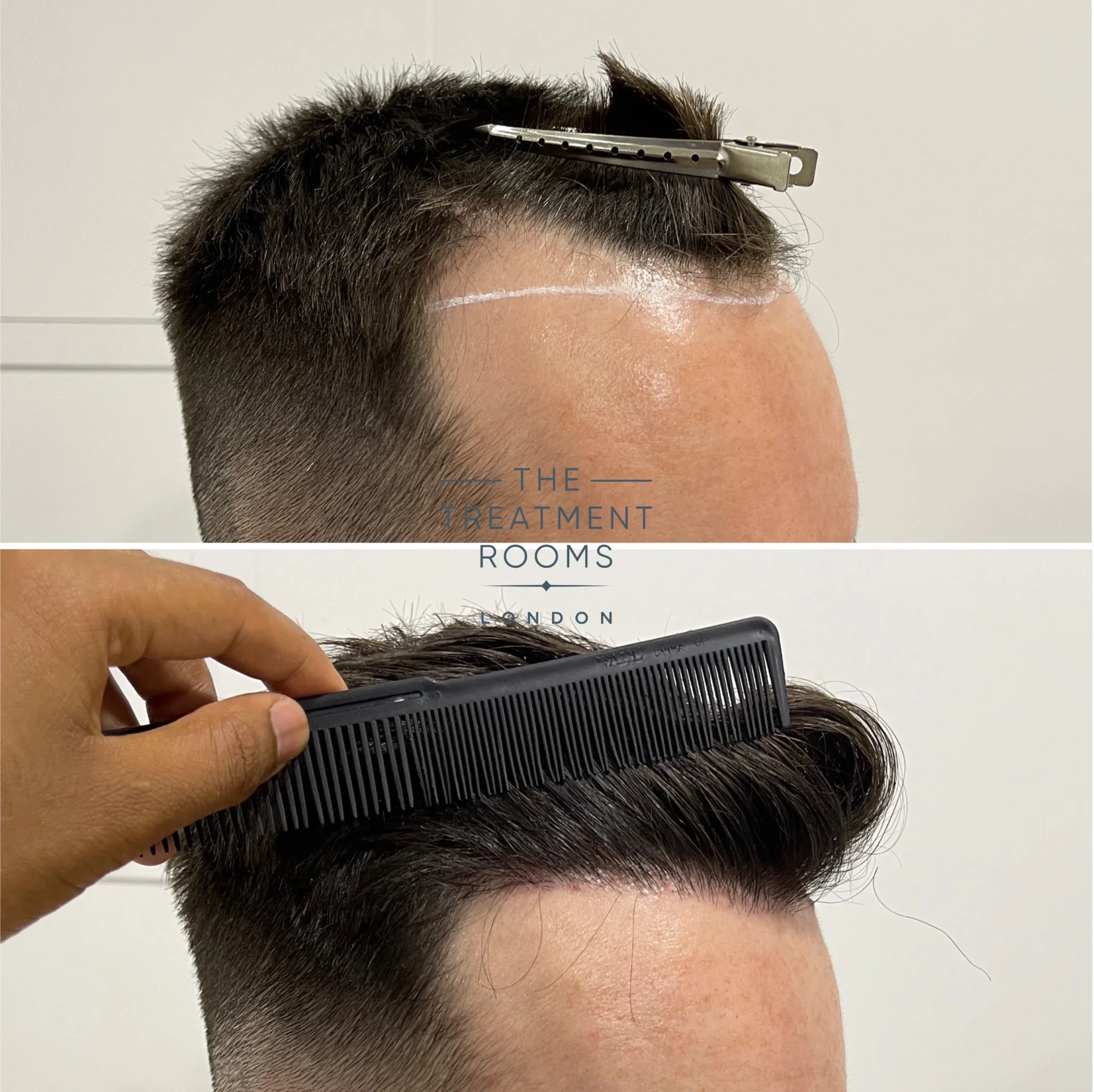 1370 grafts hairline hair transplant london before and after