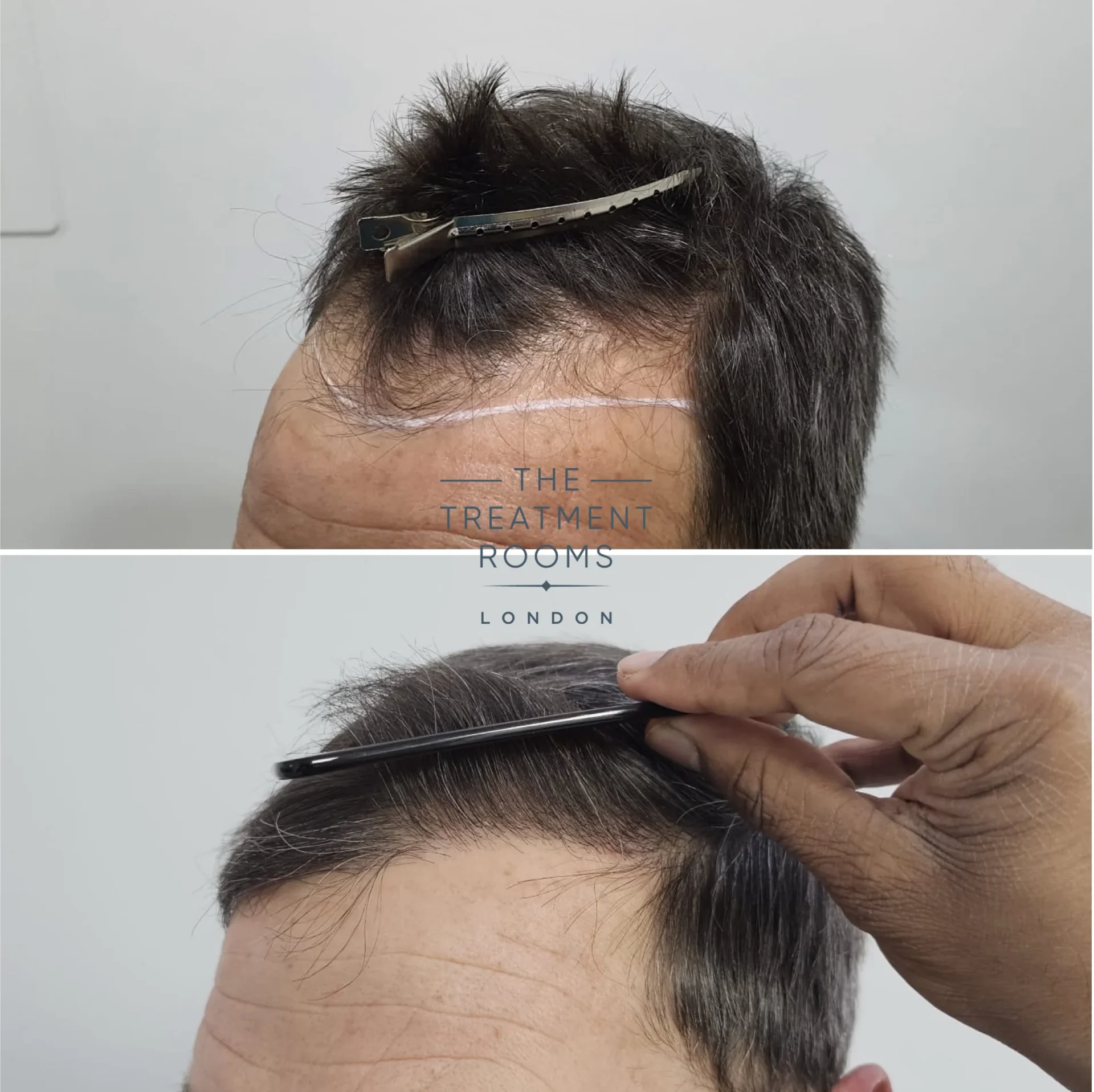 1374 grafts hair transplant hairline male
