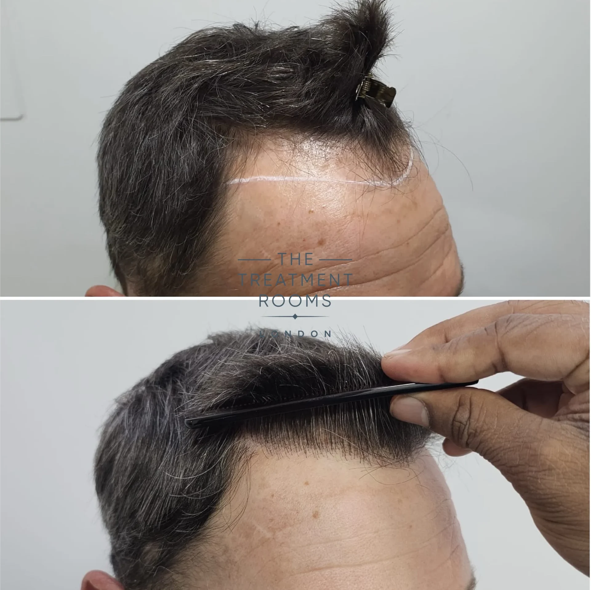 1374 grafts hair transplant hairline result