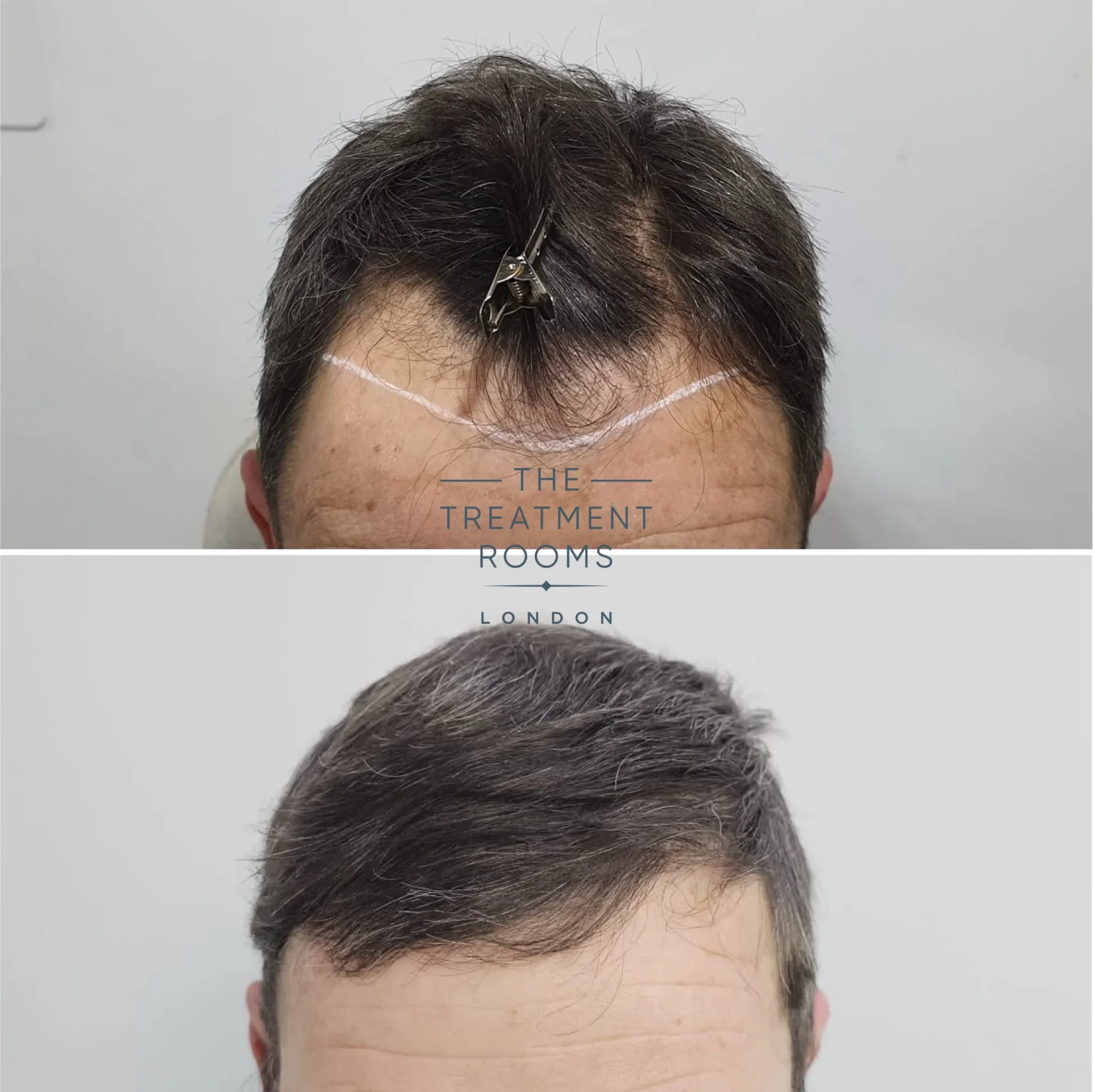 1374 grafts hair transplant receding hairline