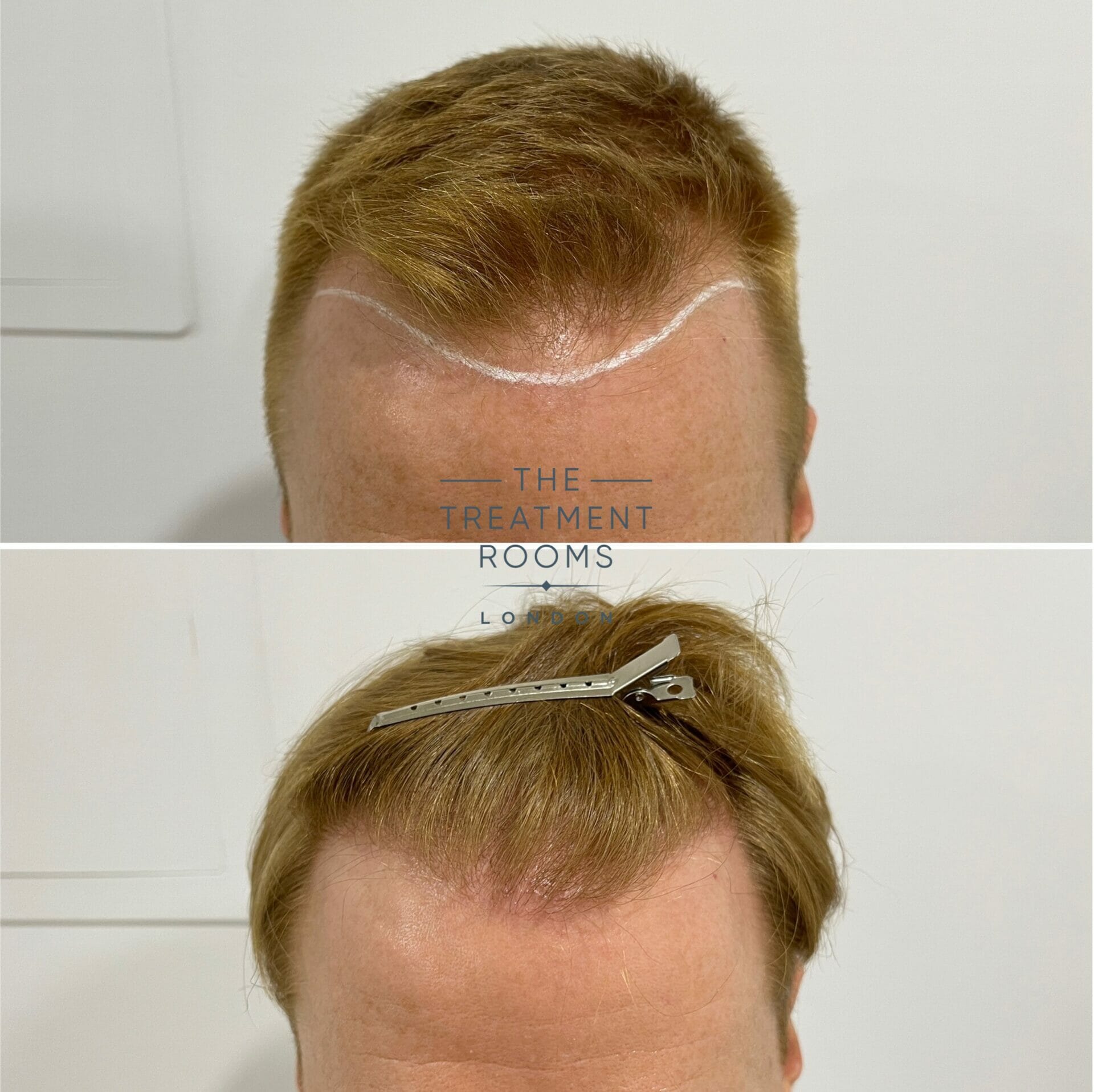 1426 grafts fue hair transplant hairline before and after