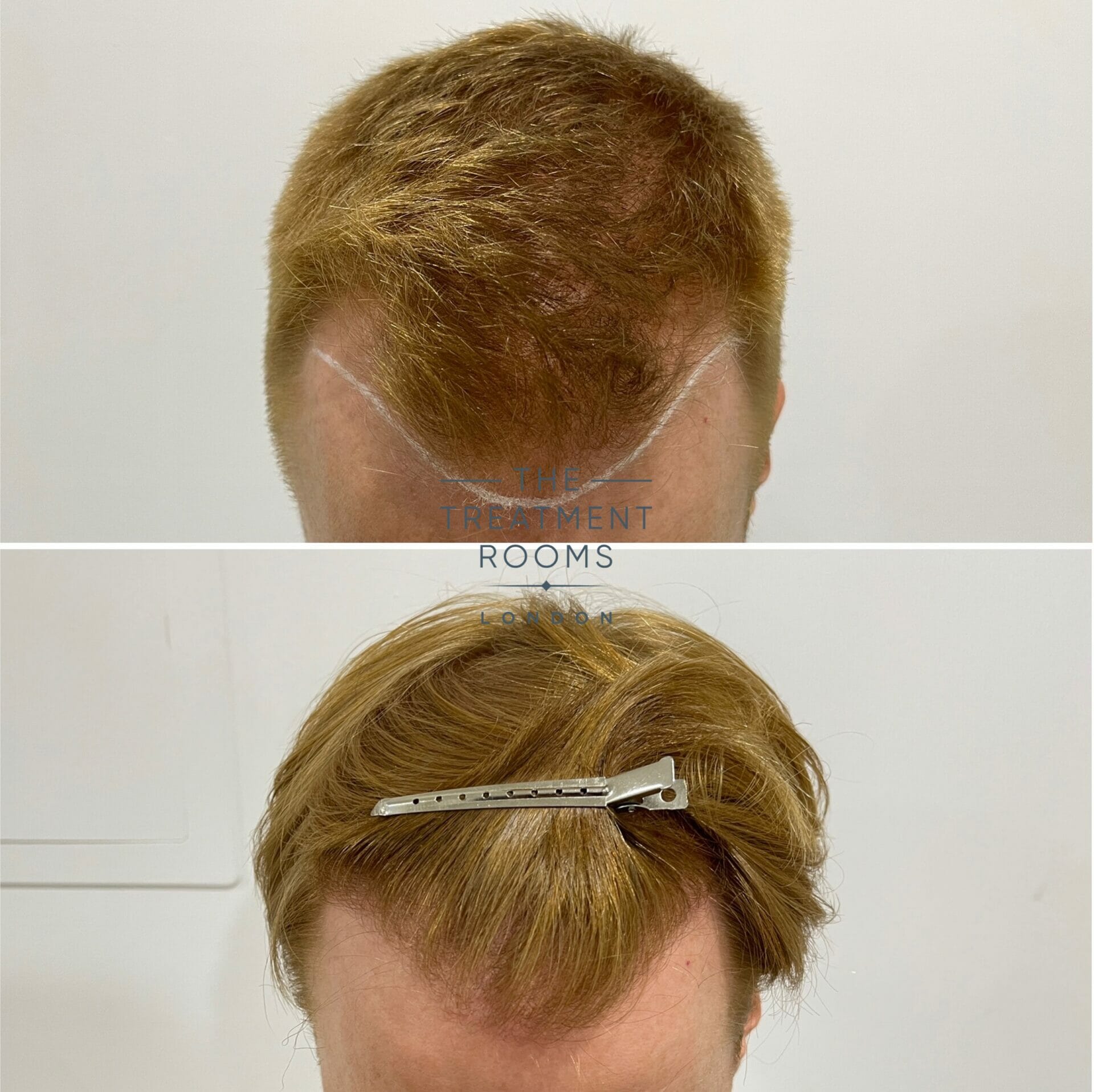 1426 grafts fue hair transplant receding hairline before and after