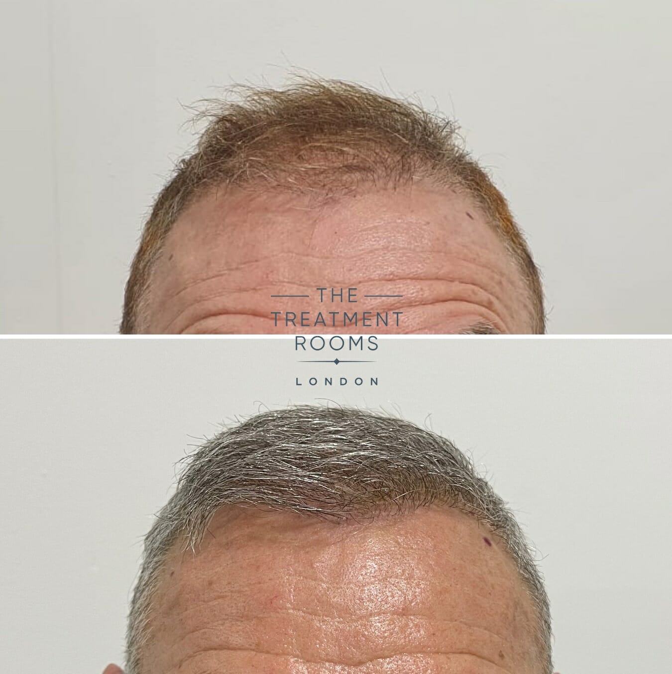 1500 graft FUE hair transplant repair