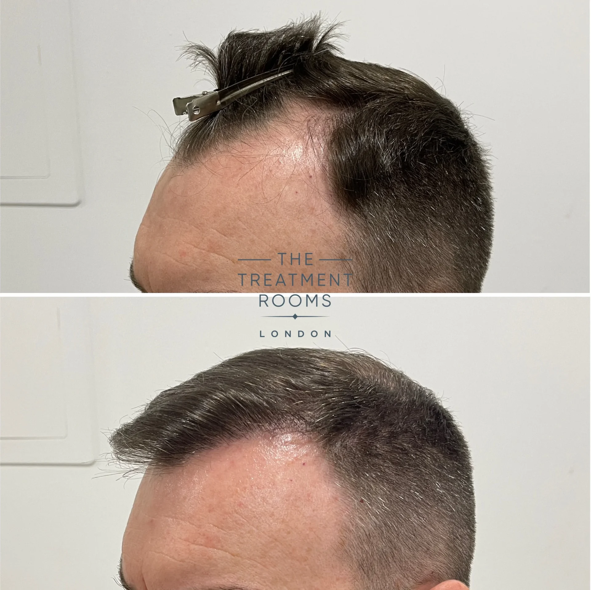 1501 grafts hairline fue hair transplant before and after