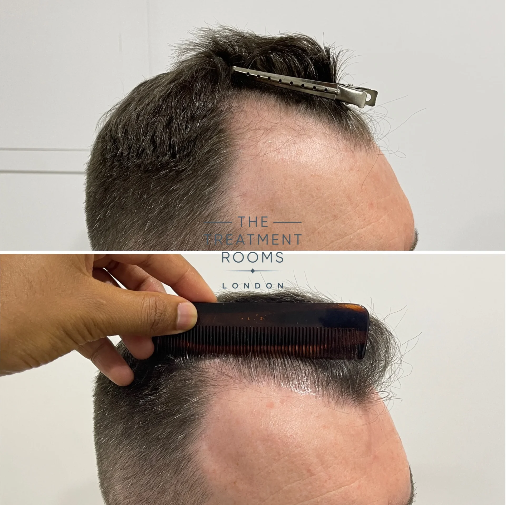 1501 grafts hairline transplant london before and after