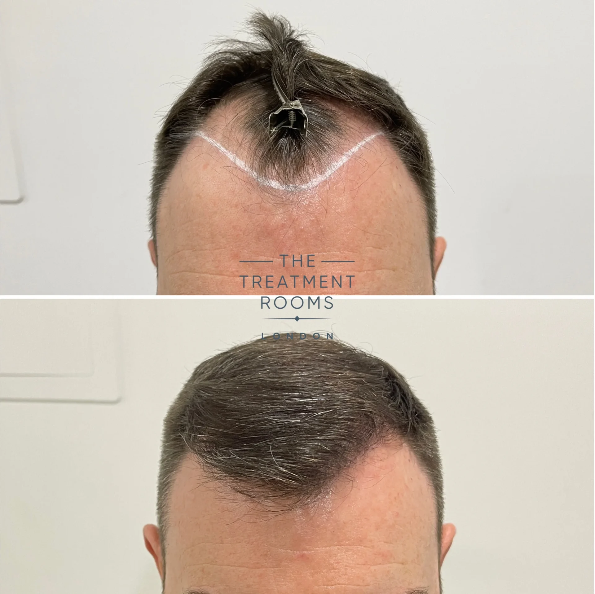 1501 grafts hairline transplant result