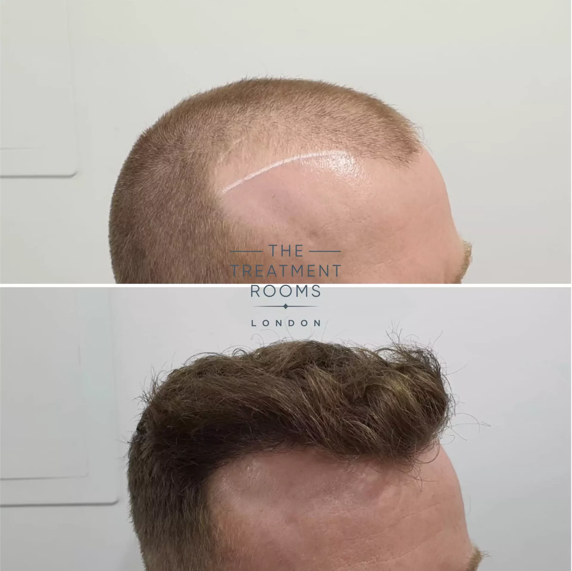 1539 grafts before and after hair transplant clinic london