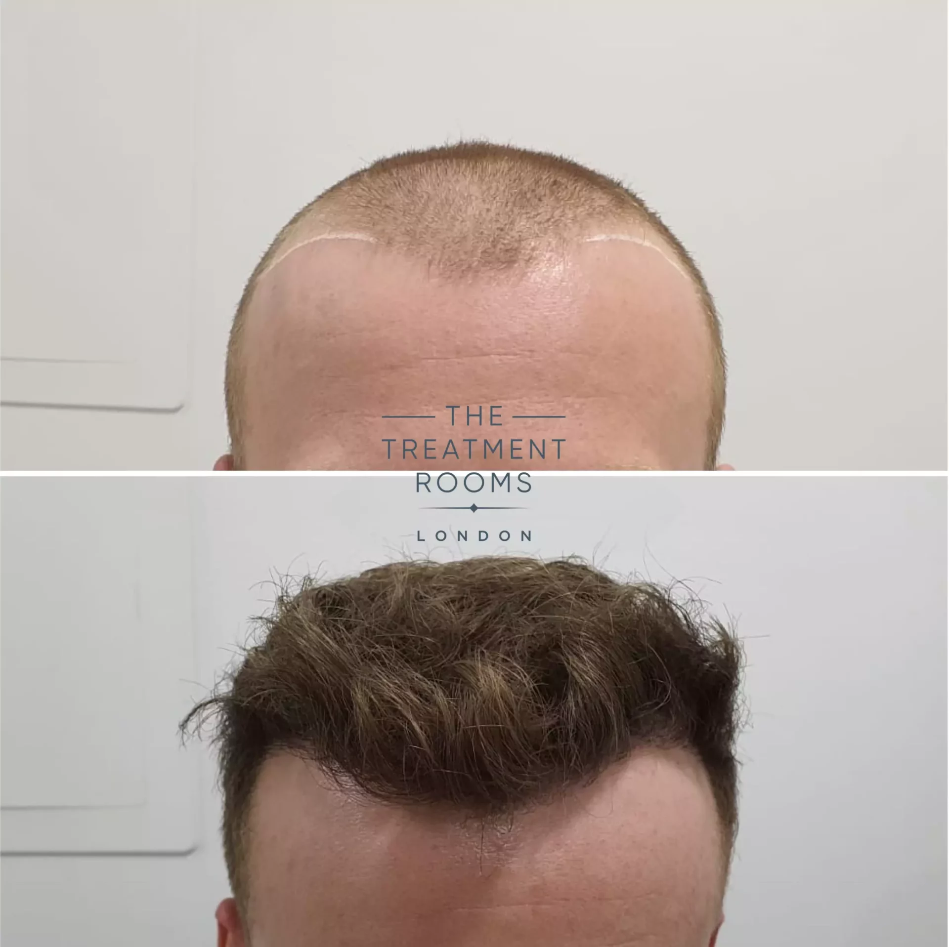 1539 grafts before and after hair transplant london