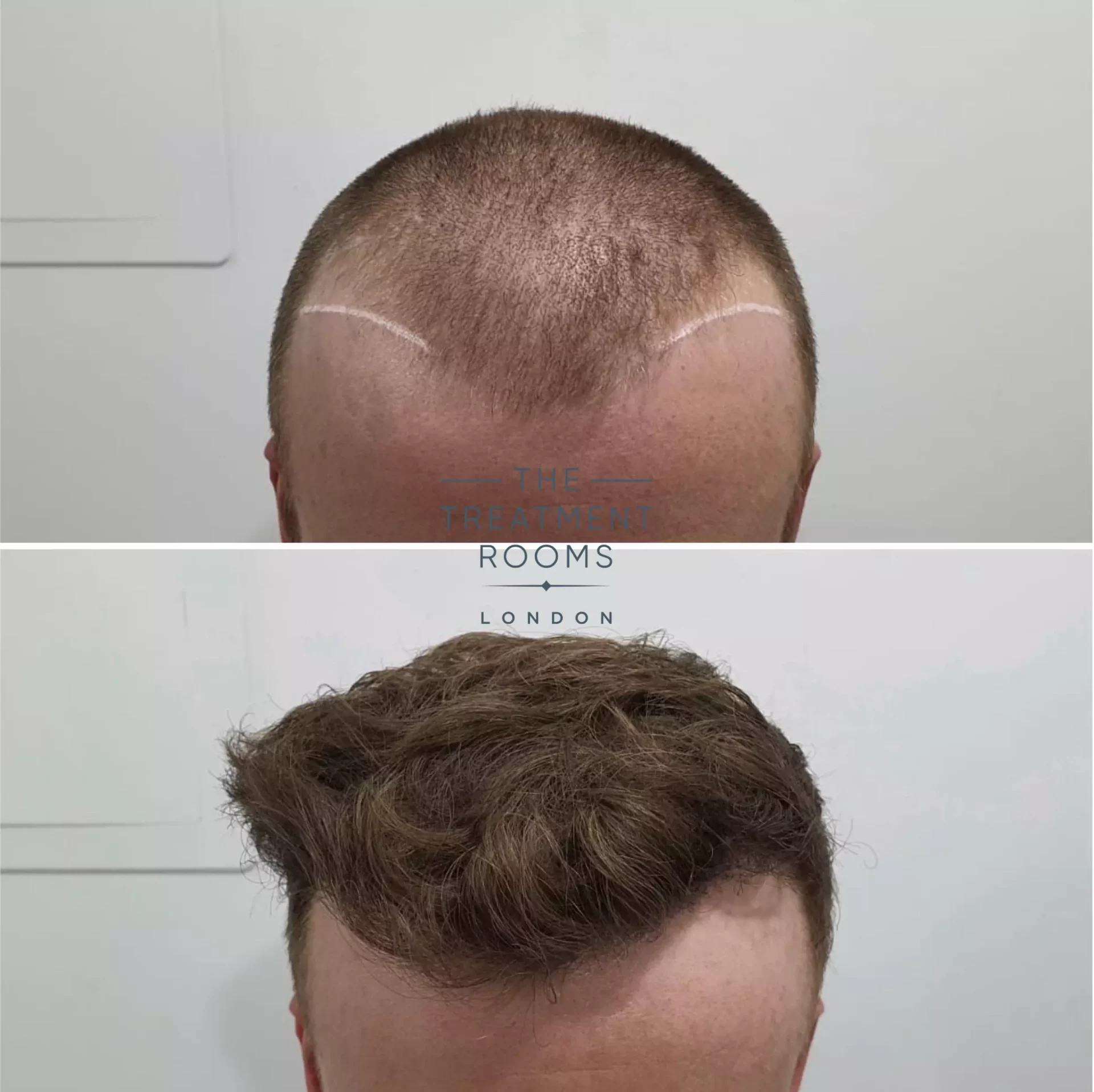 1539 grafts before and after hair transplant