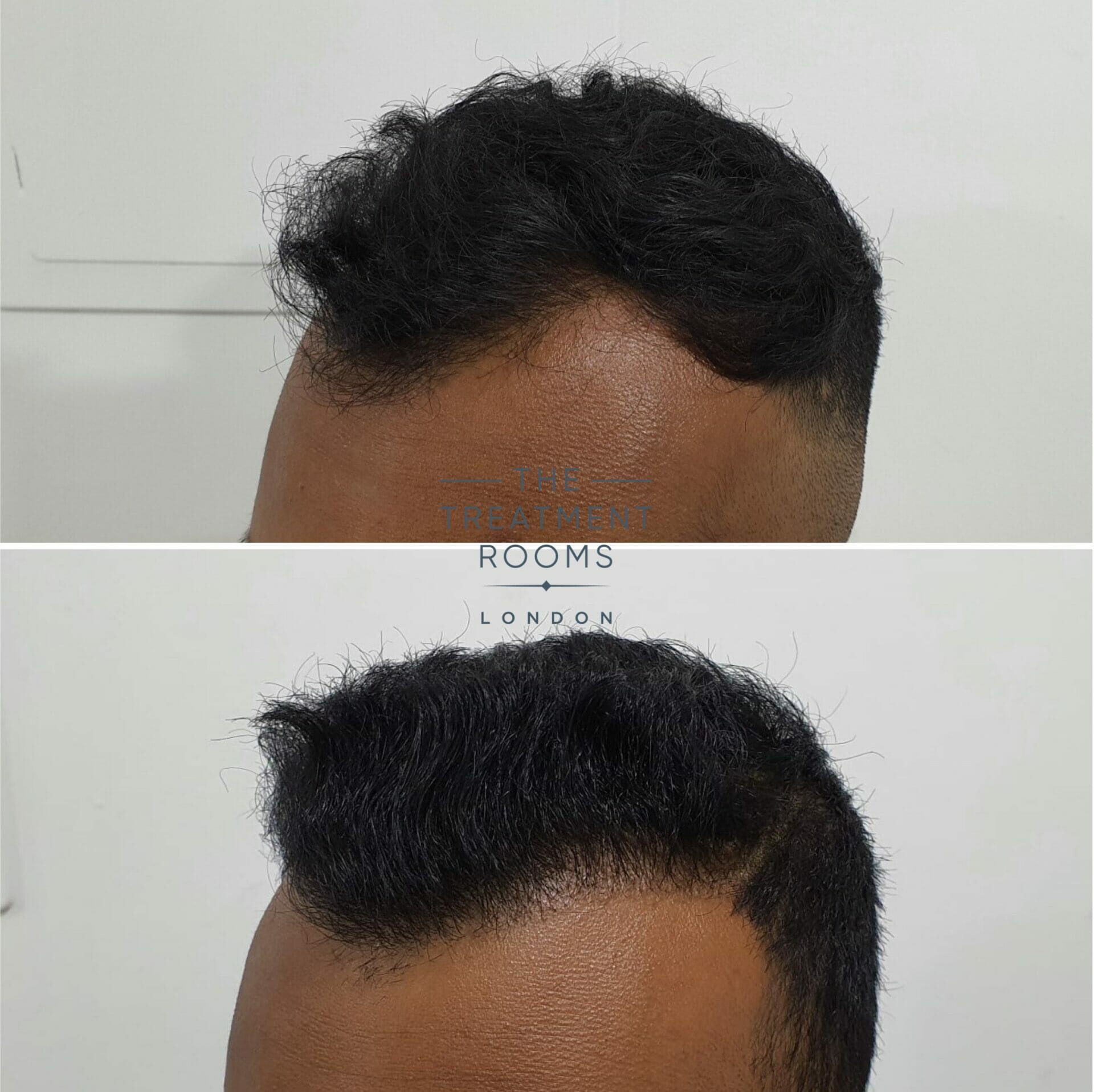 1546 grafts FUE hair transplant before and after