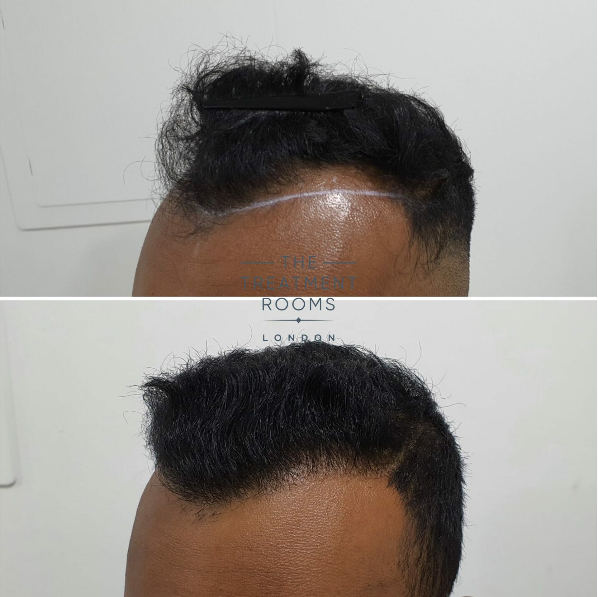 1546 grafts FUE hair transplant london before and after