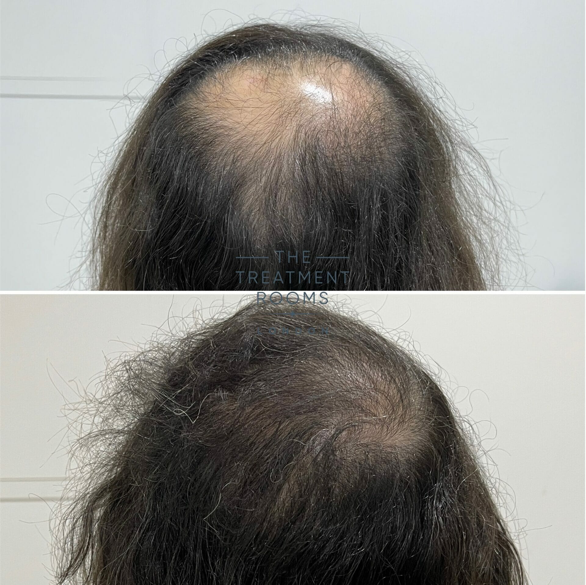 1572 grafts crown hair transplant london result