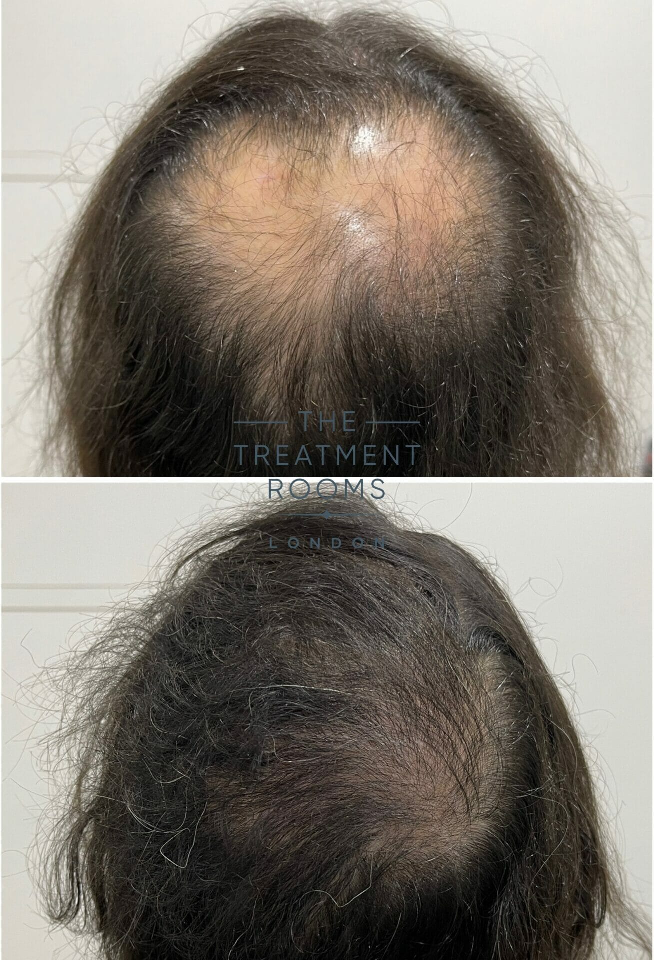 1572 grafts crown hair transplant result