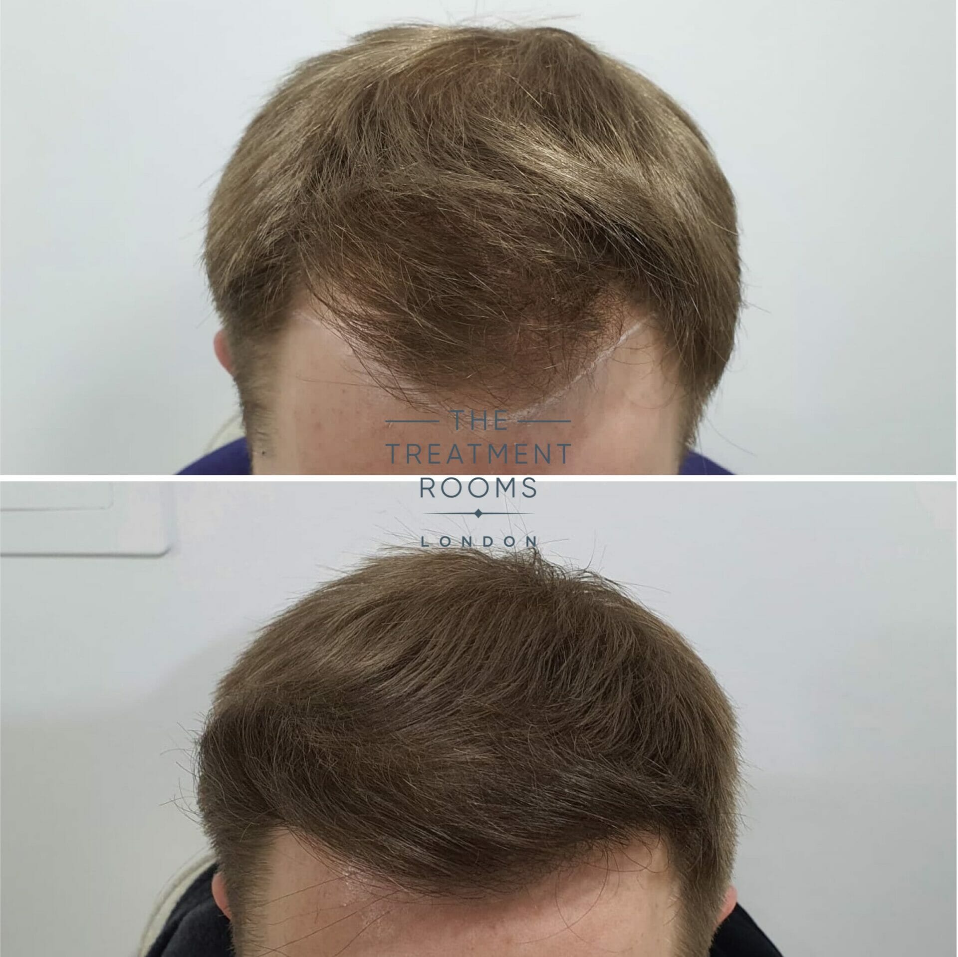 1615 grafts FUE hair transplant before and after
