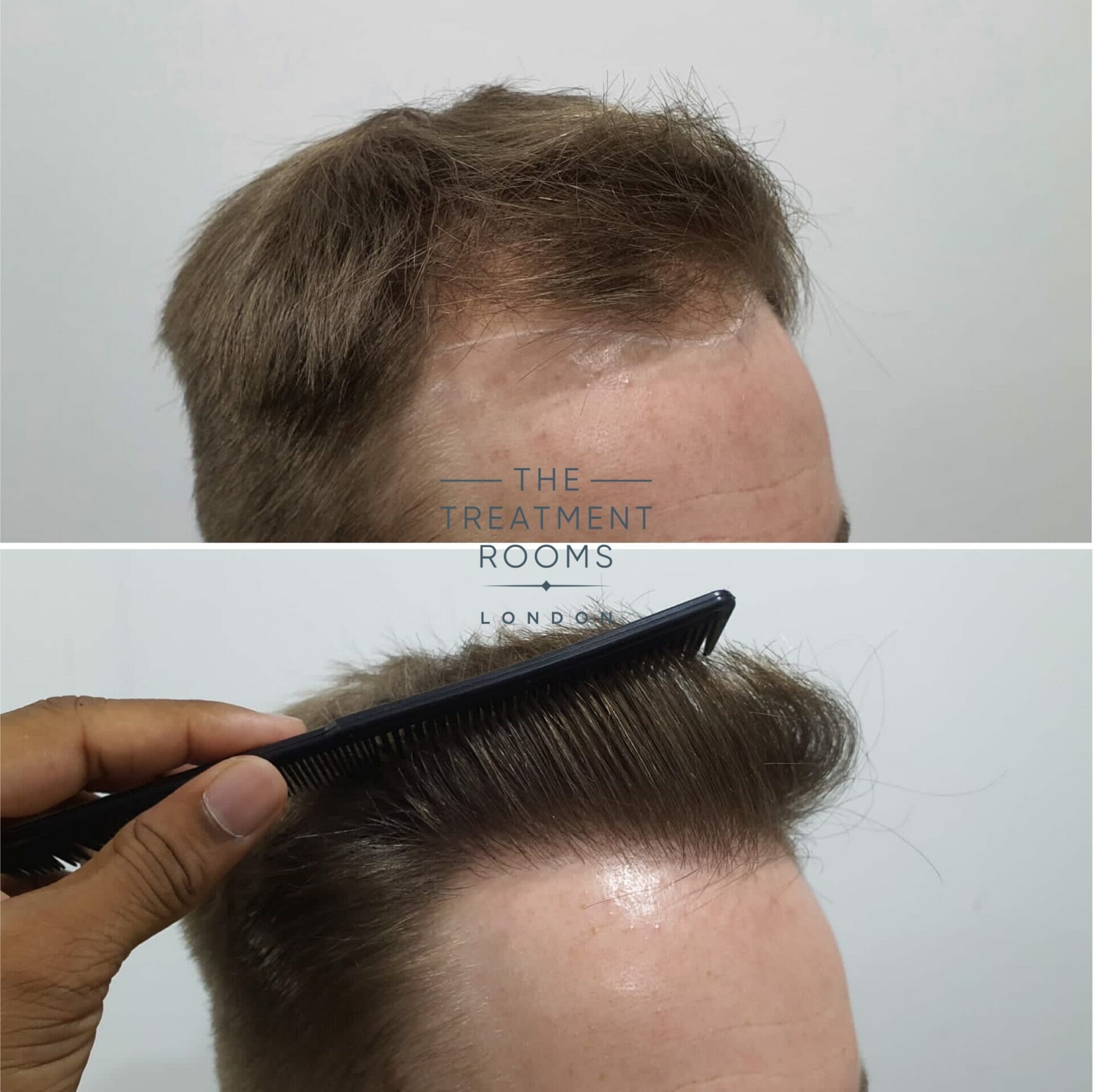 1615 grafts FUE hair transplant london