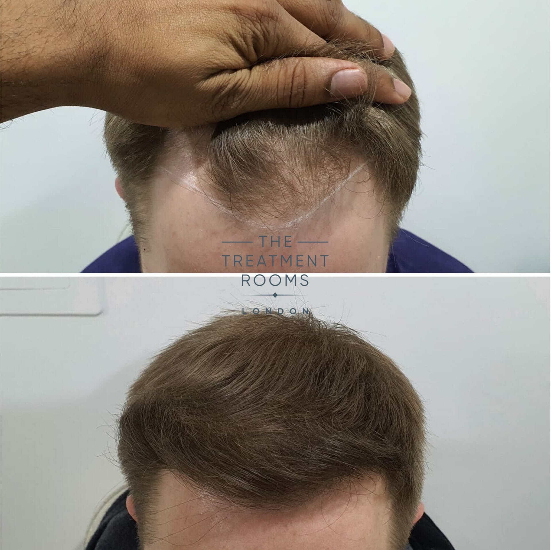 1615 grafts FUE hair transplant result