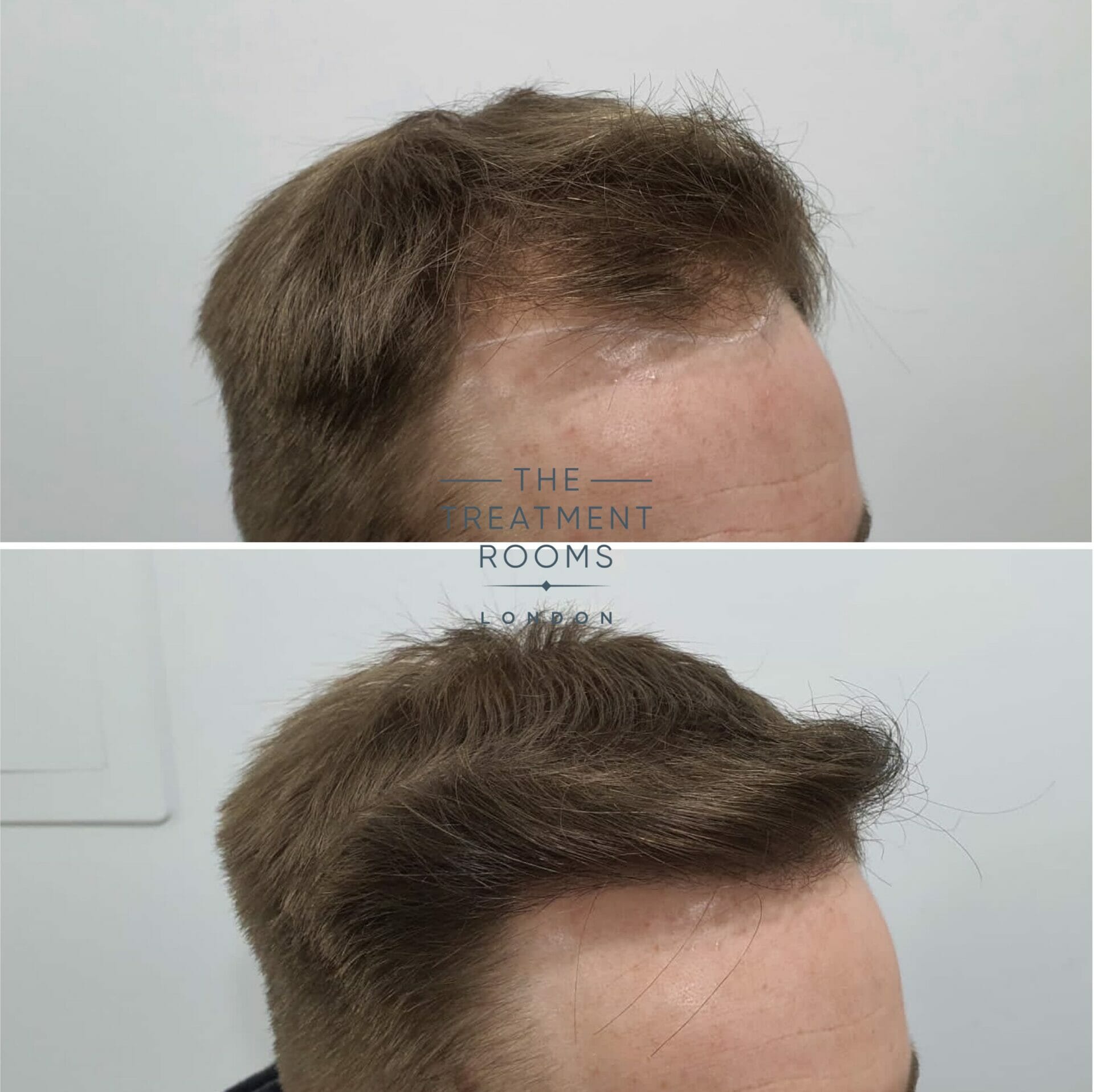 1615 grafts hair transplant london before and after