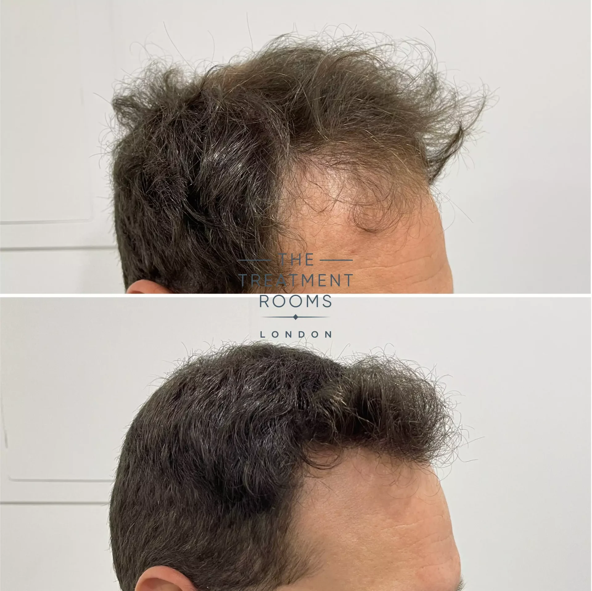 1736 grafts hair transplant before and after