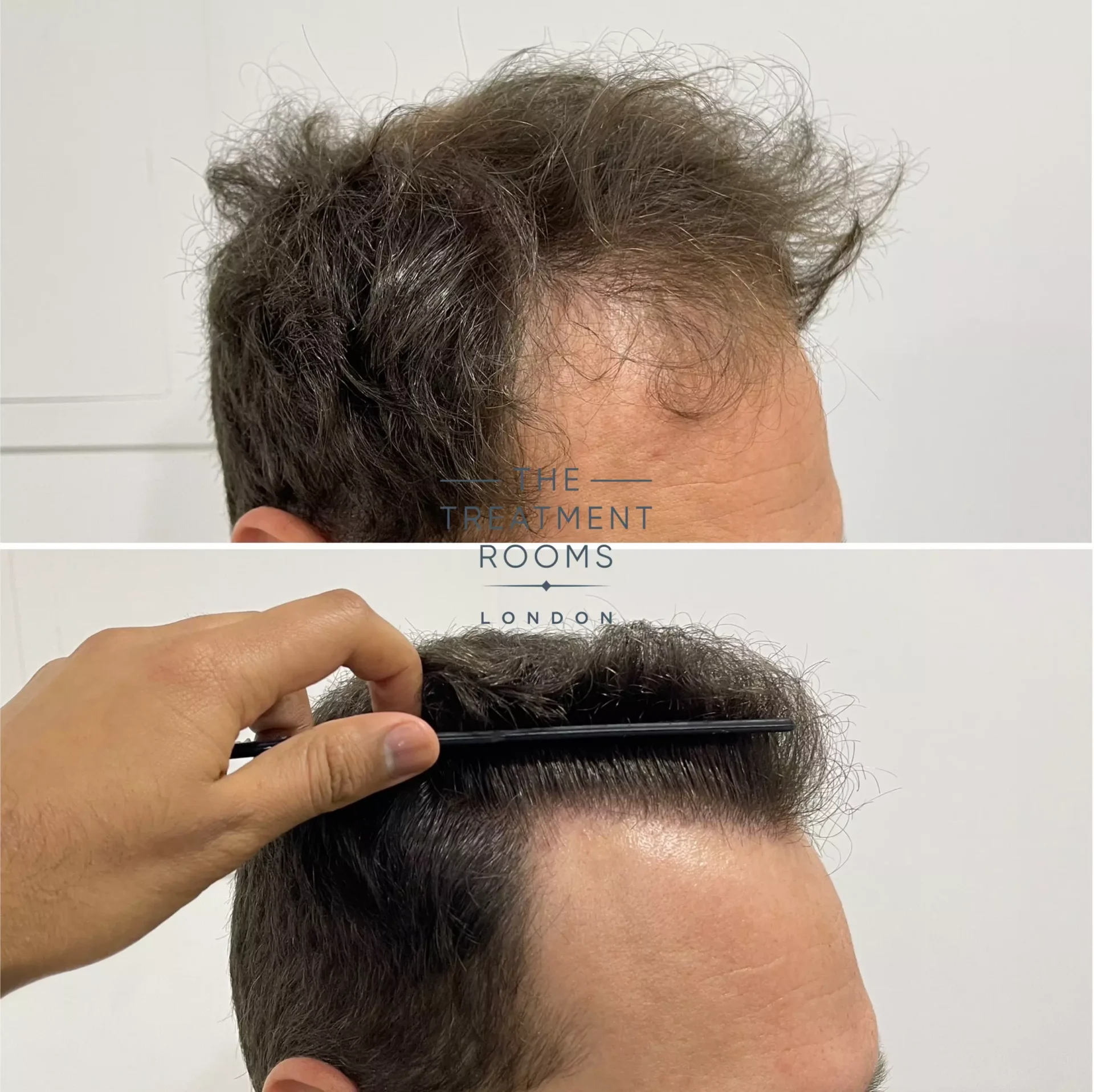 1736 grafts hairline transplant before and after