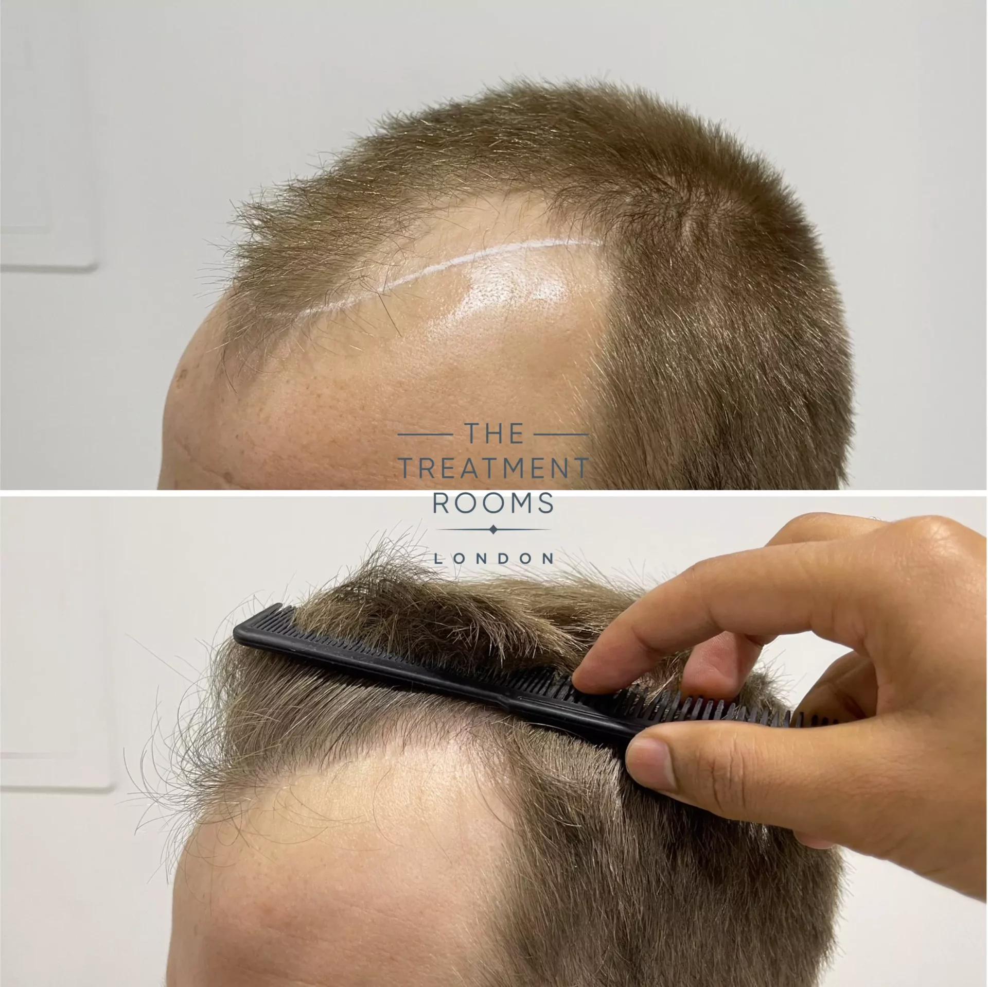 1756 grafts before and after hairline transplant