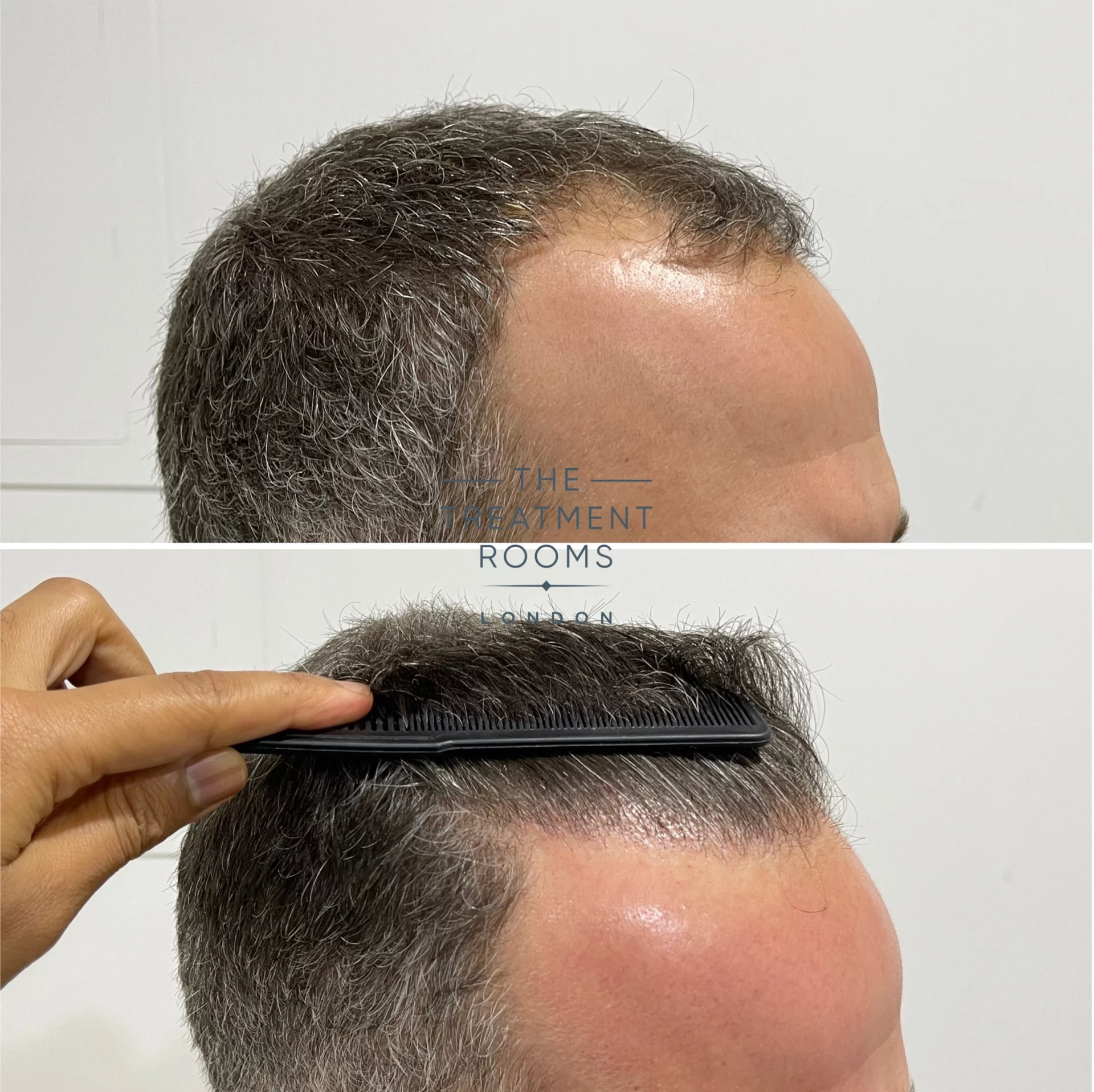 1788 grafts hair transplant before and after