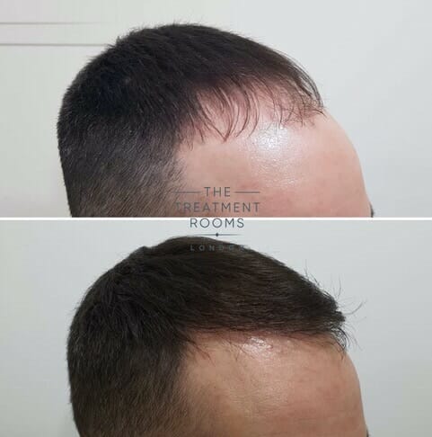 1800 graft FUE hair transplant before and after