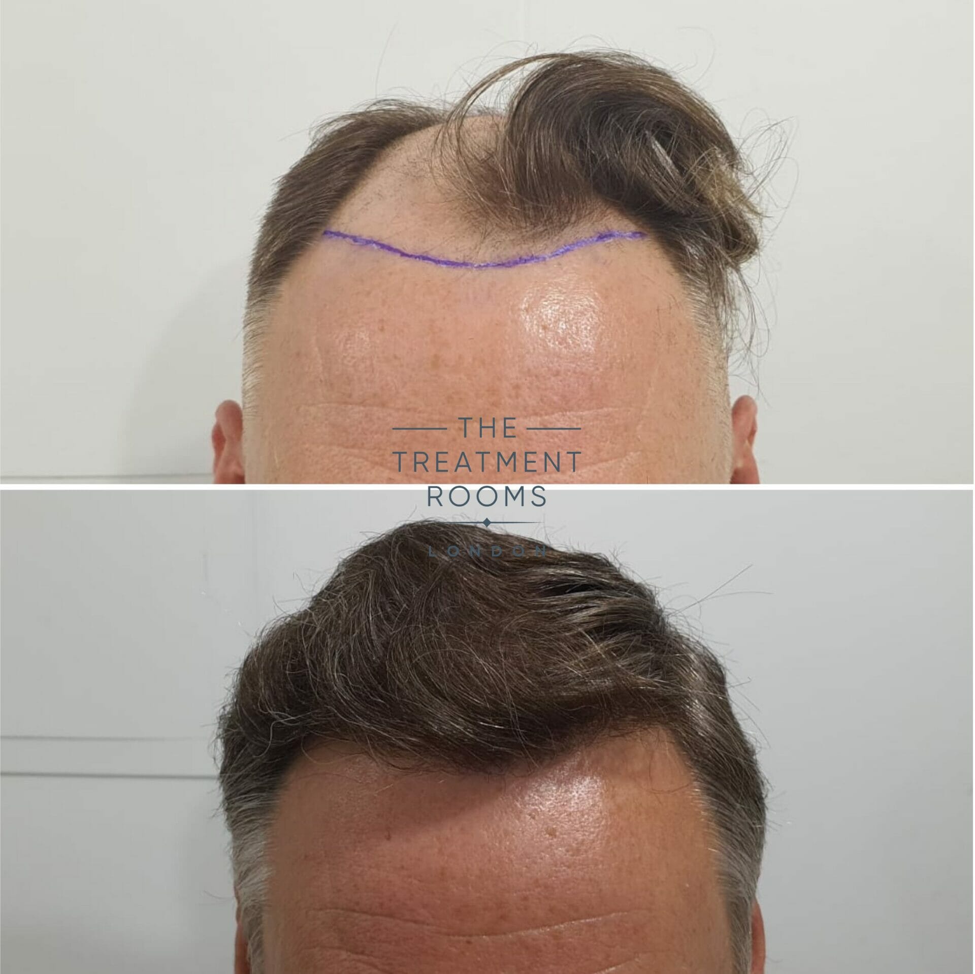 1824 grafts FUE Hair transplant before and after