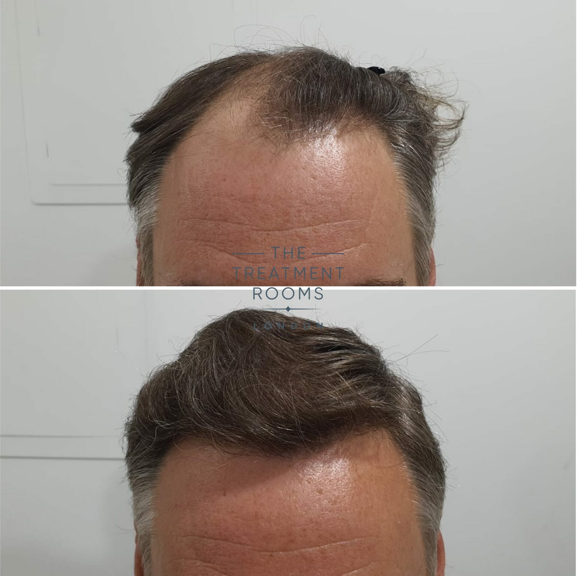 FUE Hair Transplant Result 1824 grafts - Treatment Rooms London FUE Hair Transplant Result 1824 grafts - Treatment Rooms London