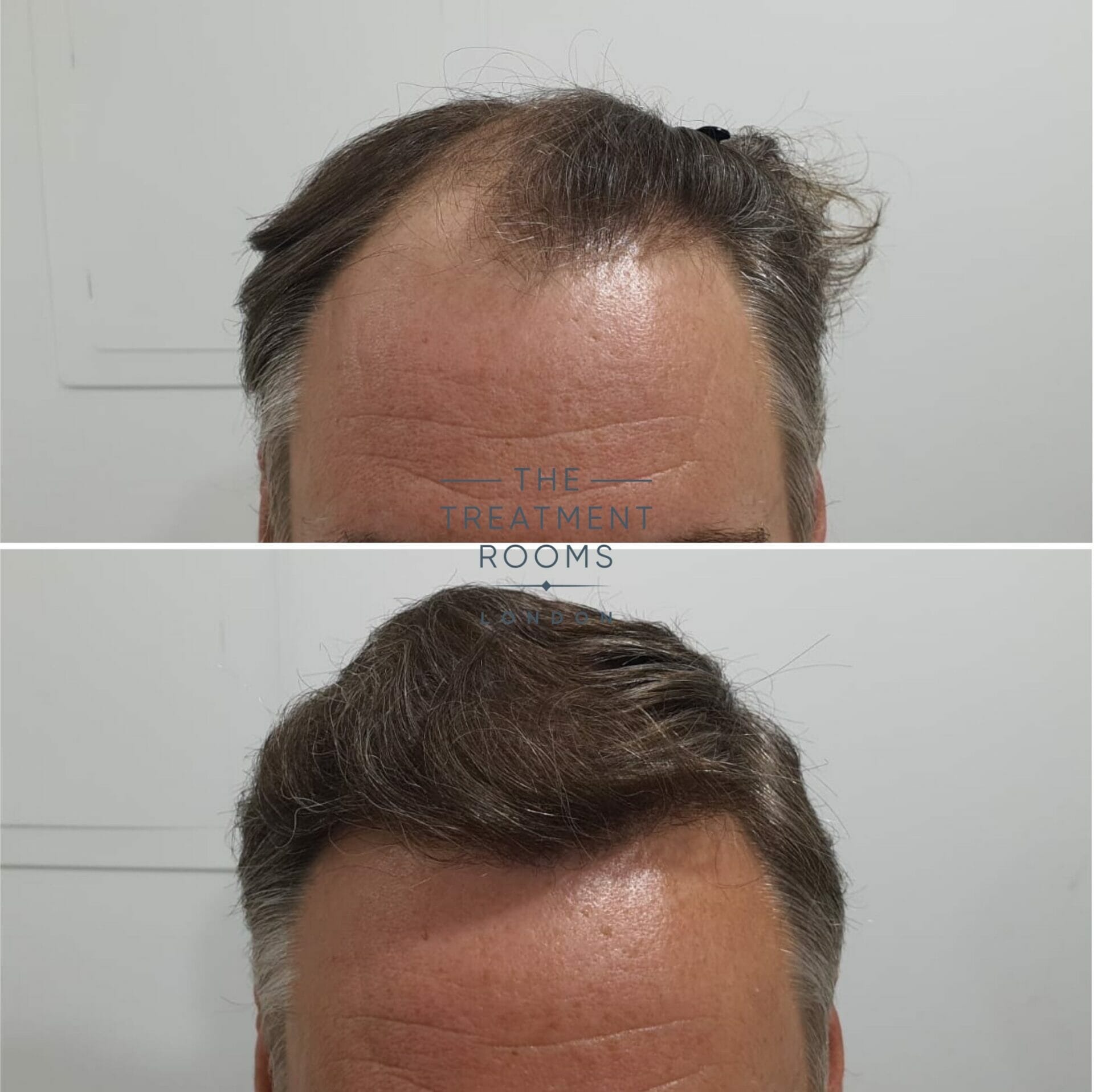 1824 grafts FUE Hair transplant hairline before and after