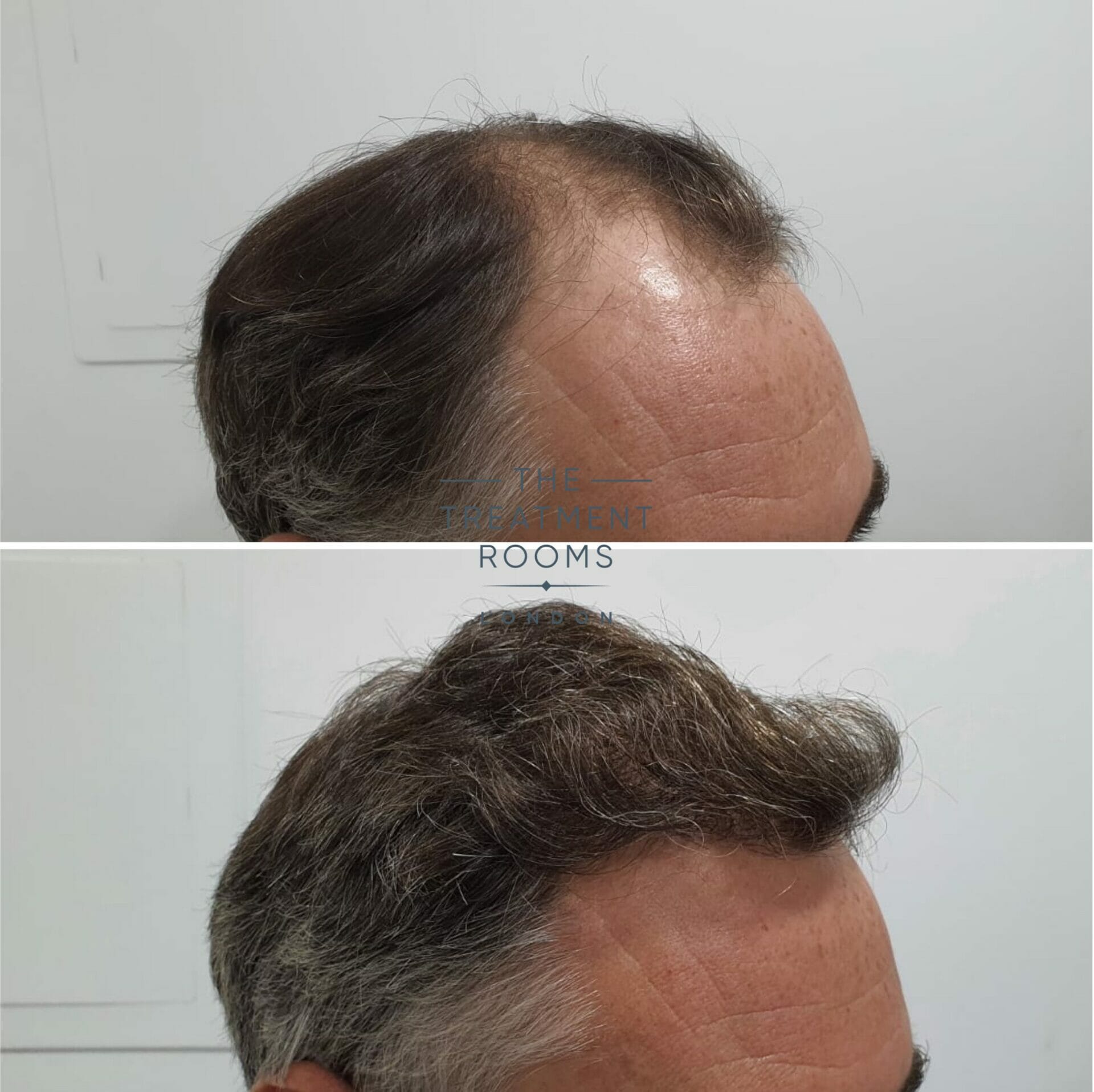 1824 grafts FUE Hair transplant london. jpg